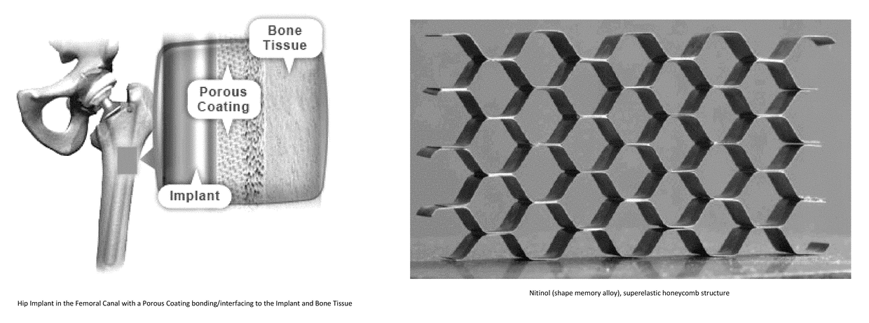 Porous coating for orthopedic implant utilizing porous, shape memory materials