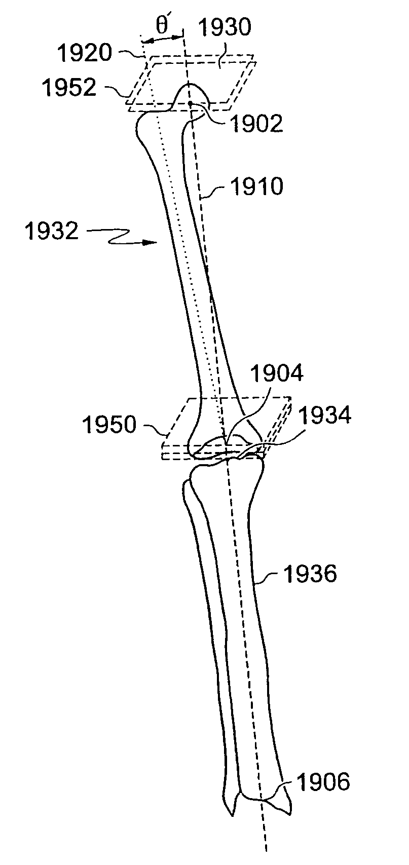 Patient selectable joint arthroplasty devices and surgical tools facilitating increased accuracy, speed and simplicity in performing total and partial joint arthroplasty