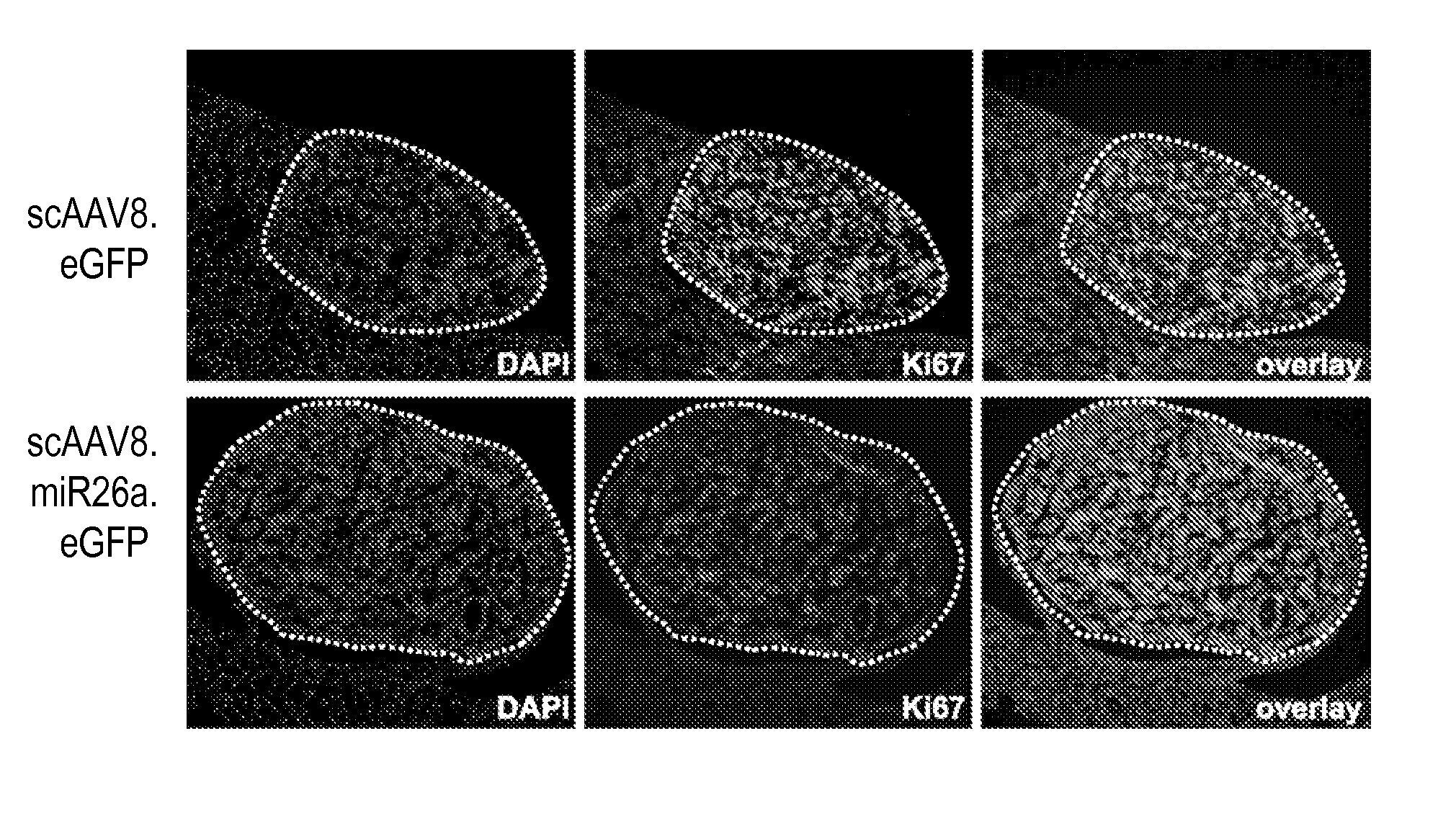 Compositions and methods for treating hepatic neoplasia