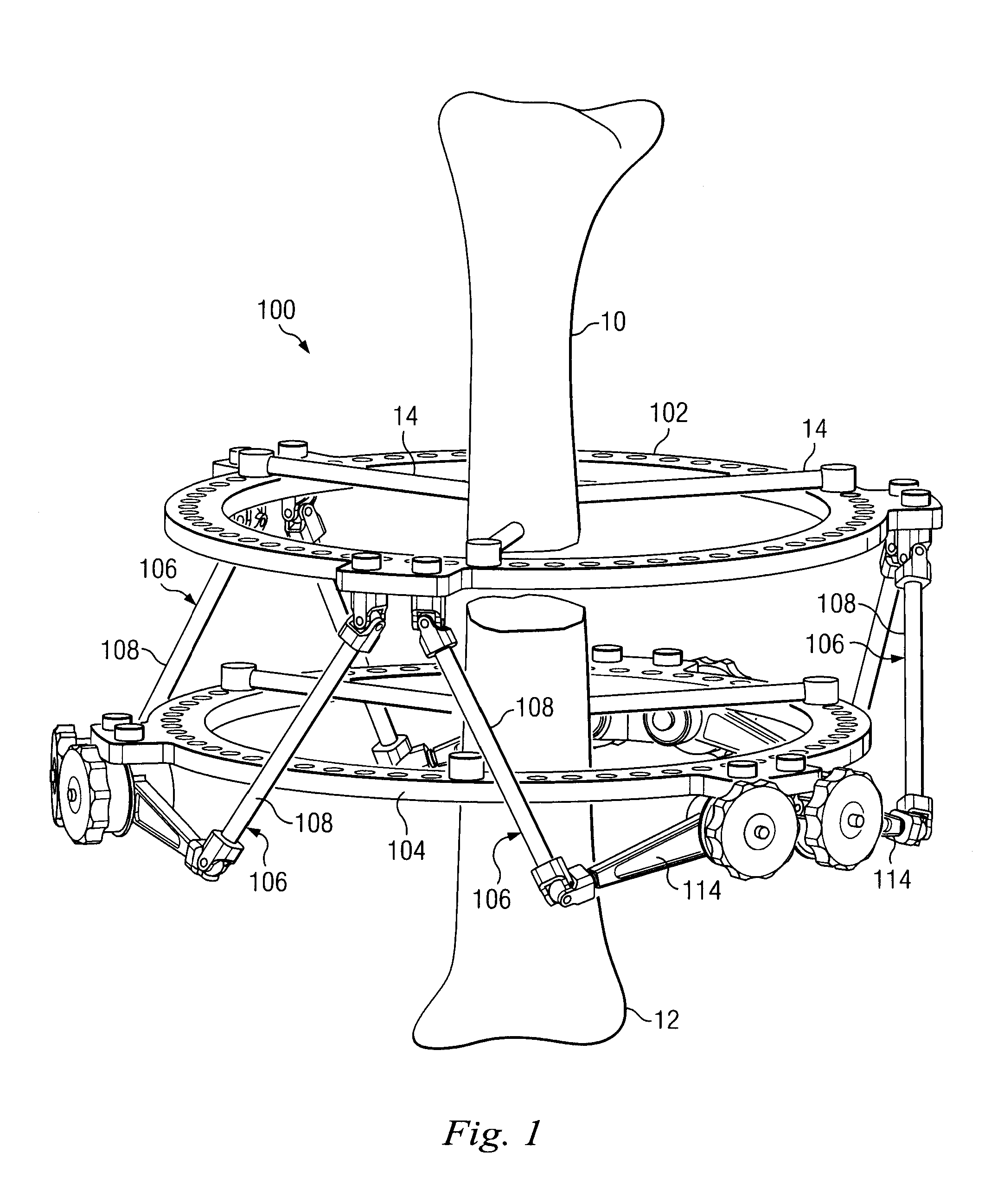 Hexapod External Fixation System with Collapsing Connectors