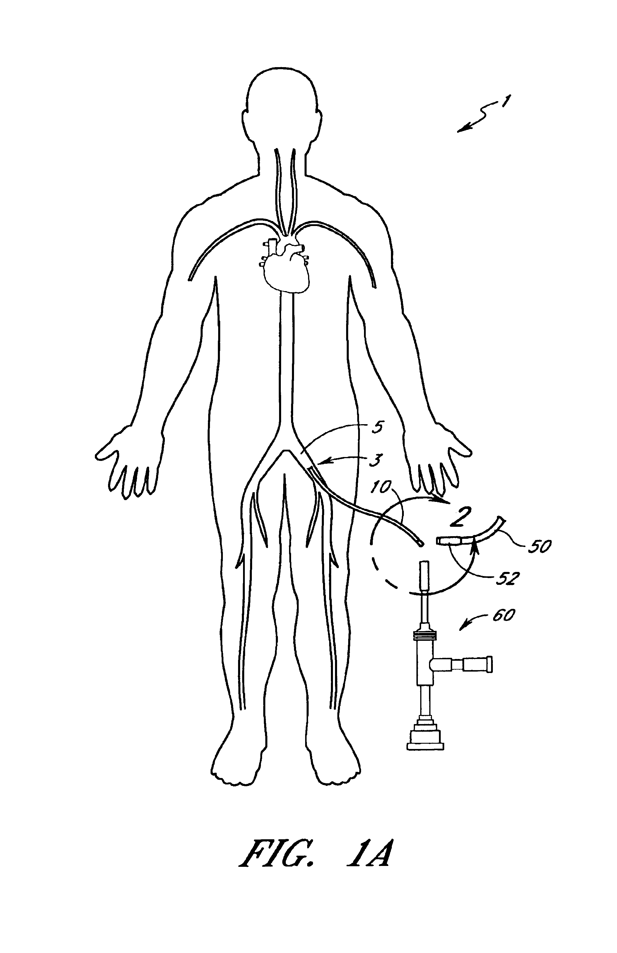 Exchange method for emboli containment