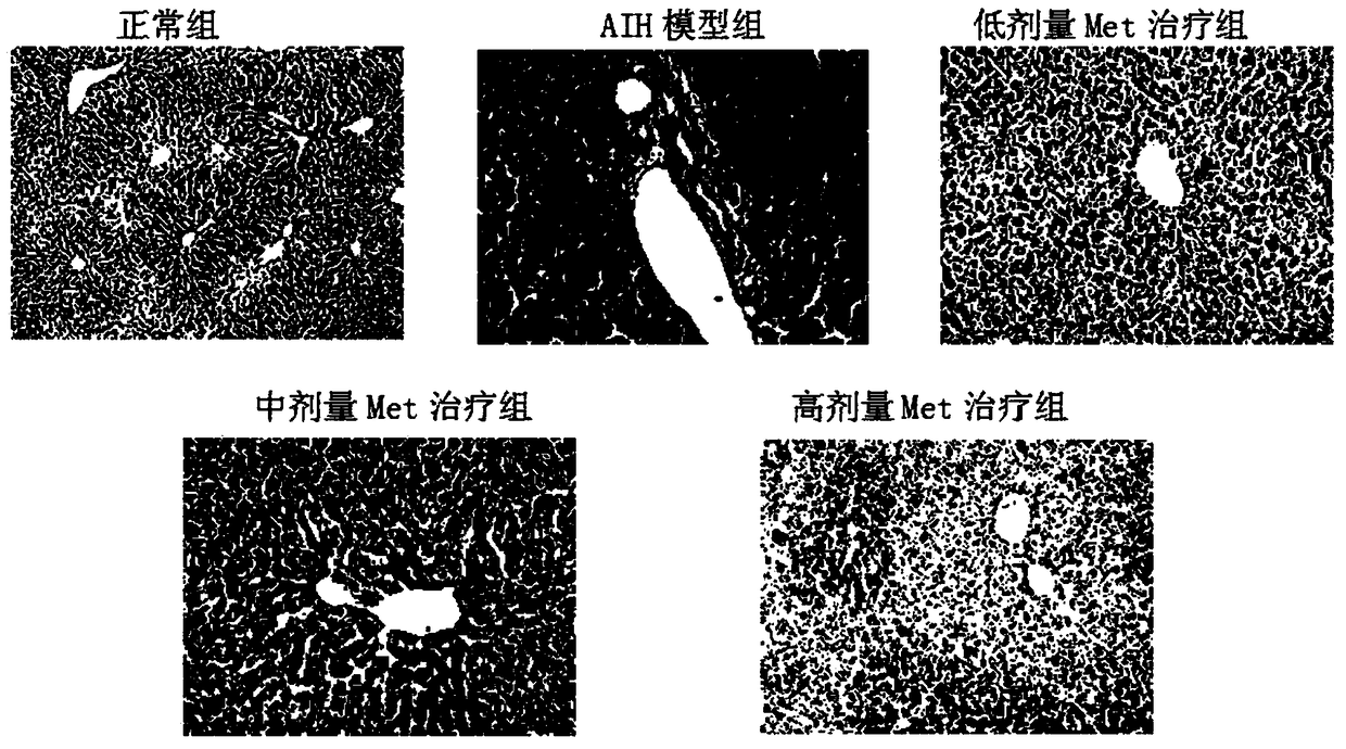 Application of metformin in treatment of autoimmune hepatitis of mouse