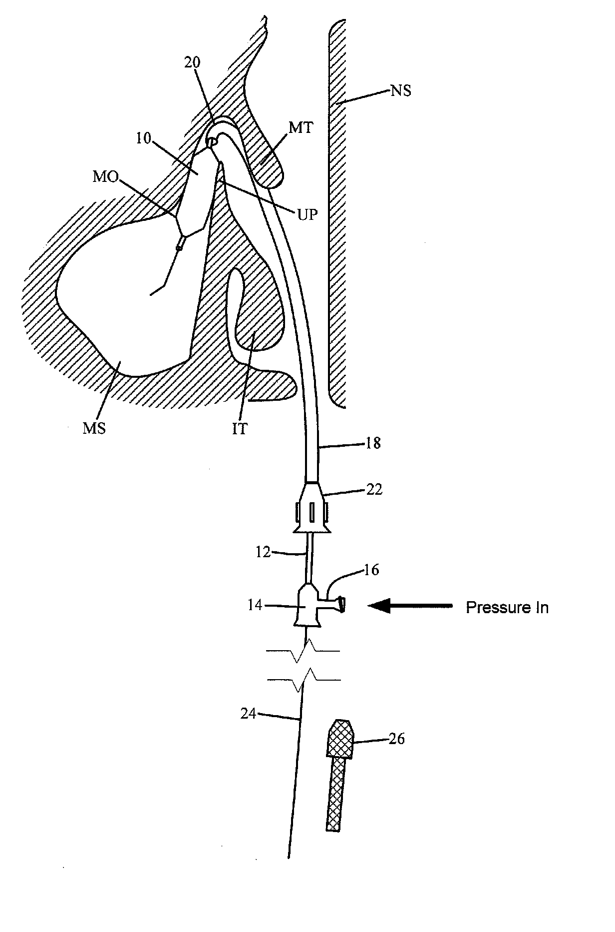 Device and method for treatment of sinusitus