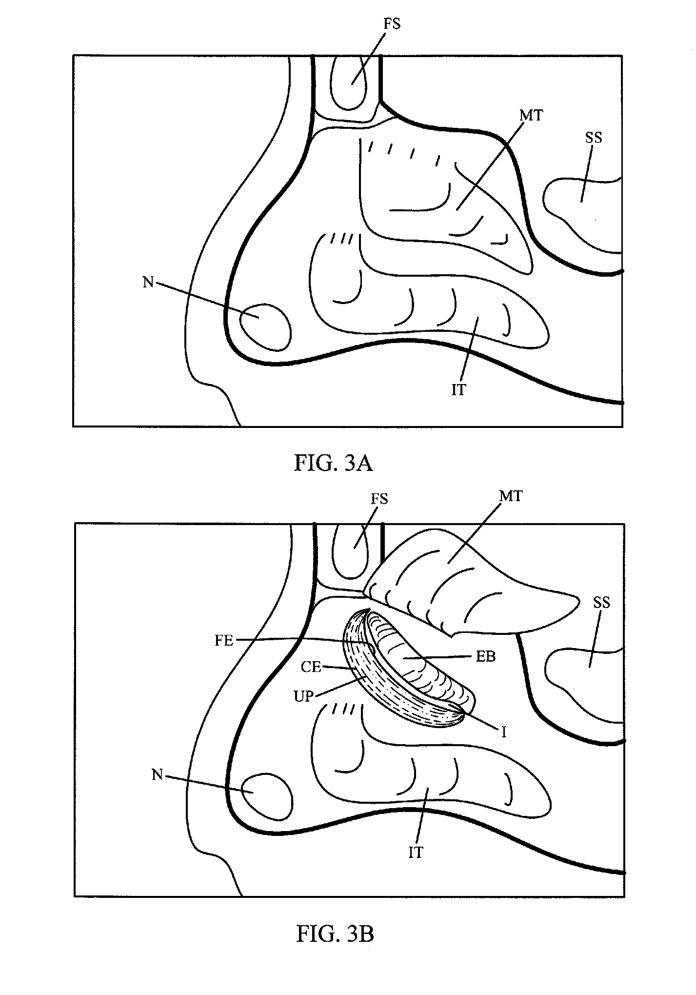 Device and method for treatment of sinusitus