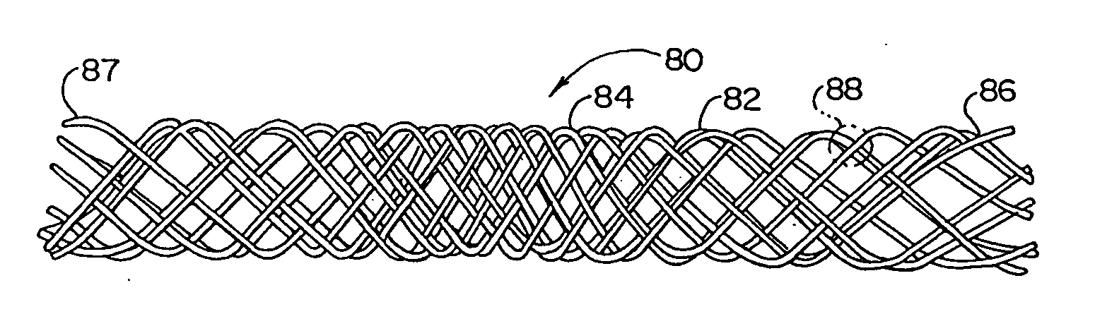 Variable expansion force stent