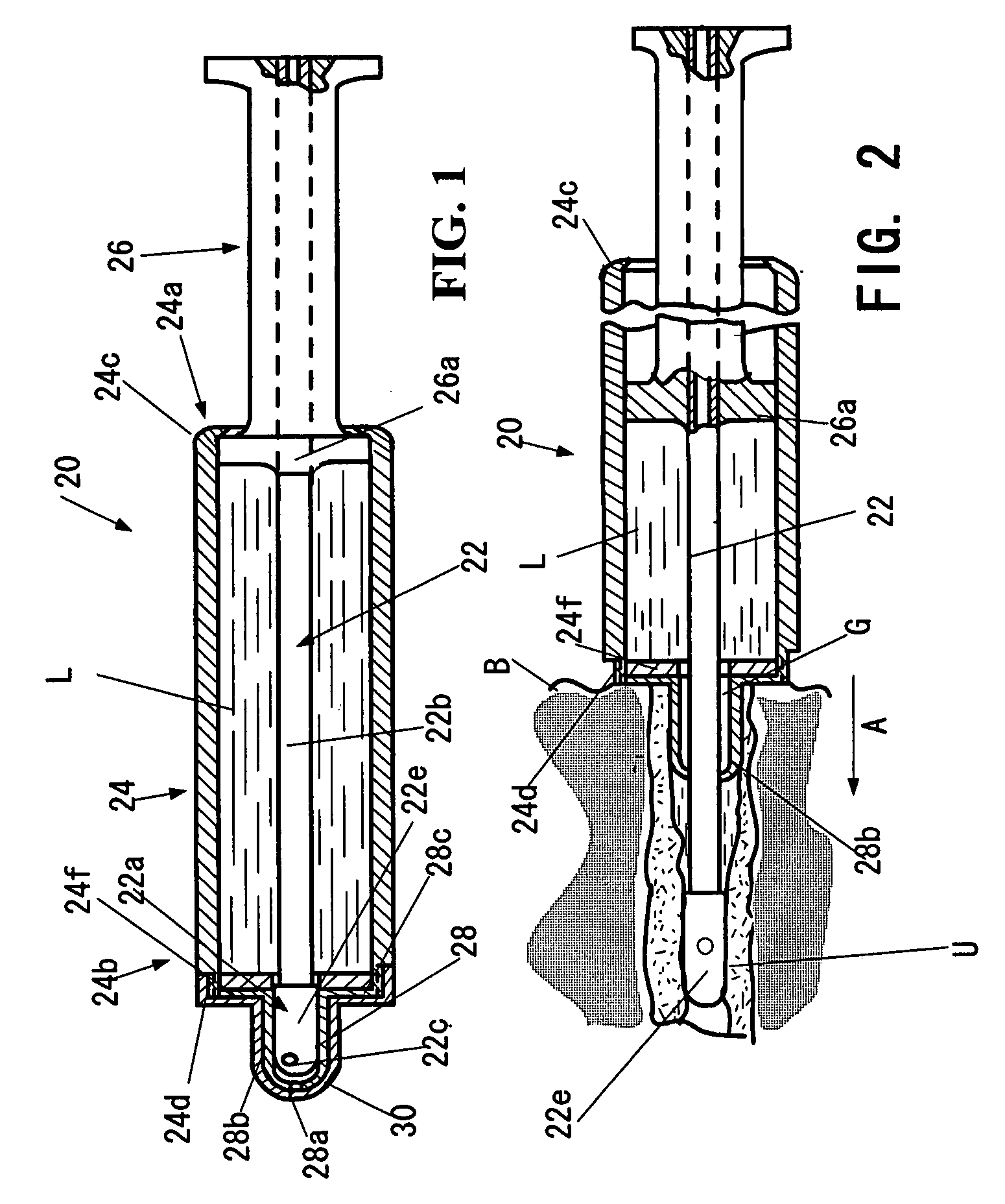 Urethral catheter assembly for combining catheterization with injection of therapeutic liquid into the urethral channel