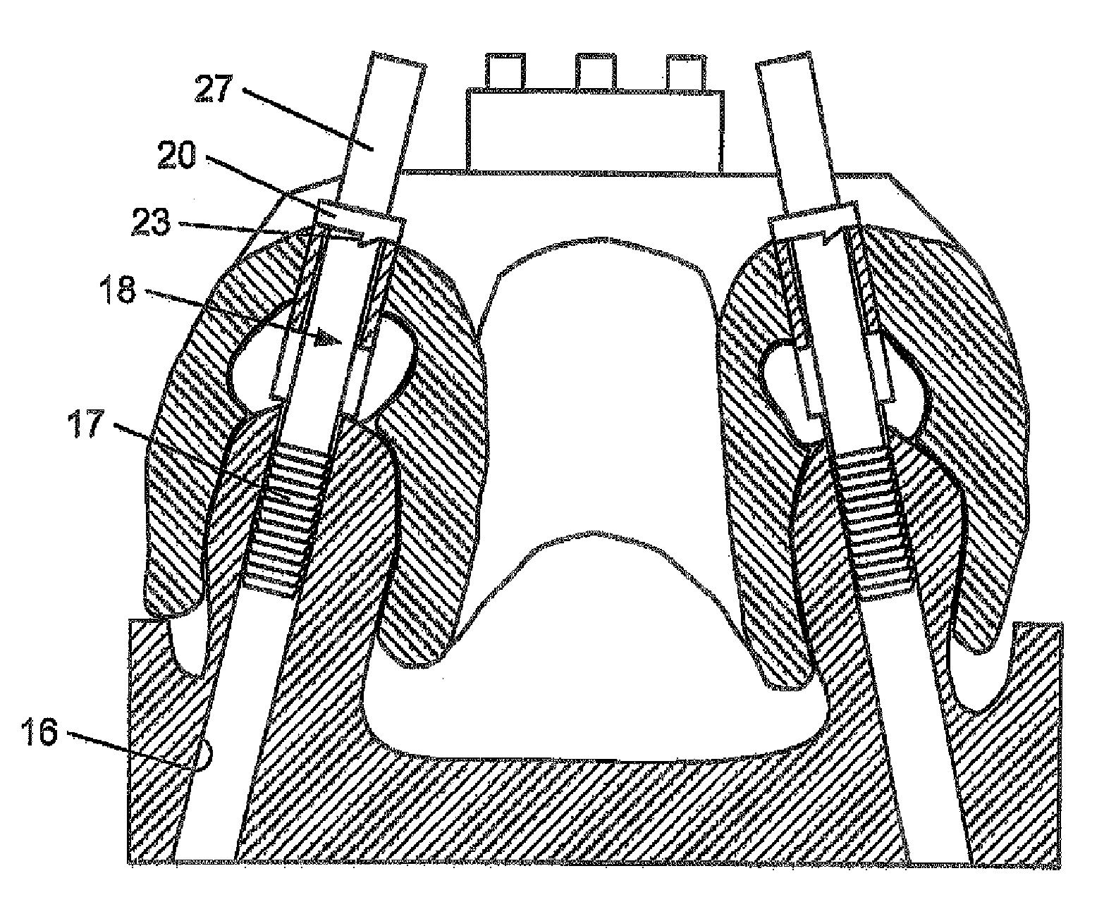 Method for manufacturing a dental prosthesis and an appliance for implantation thereof