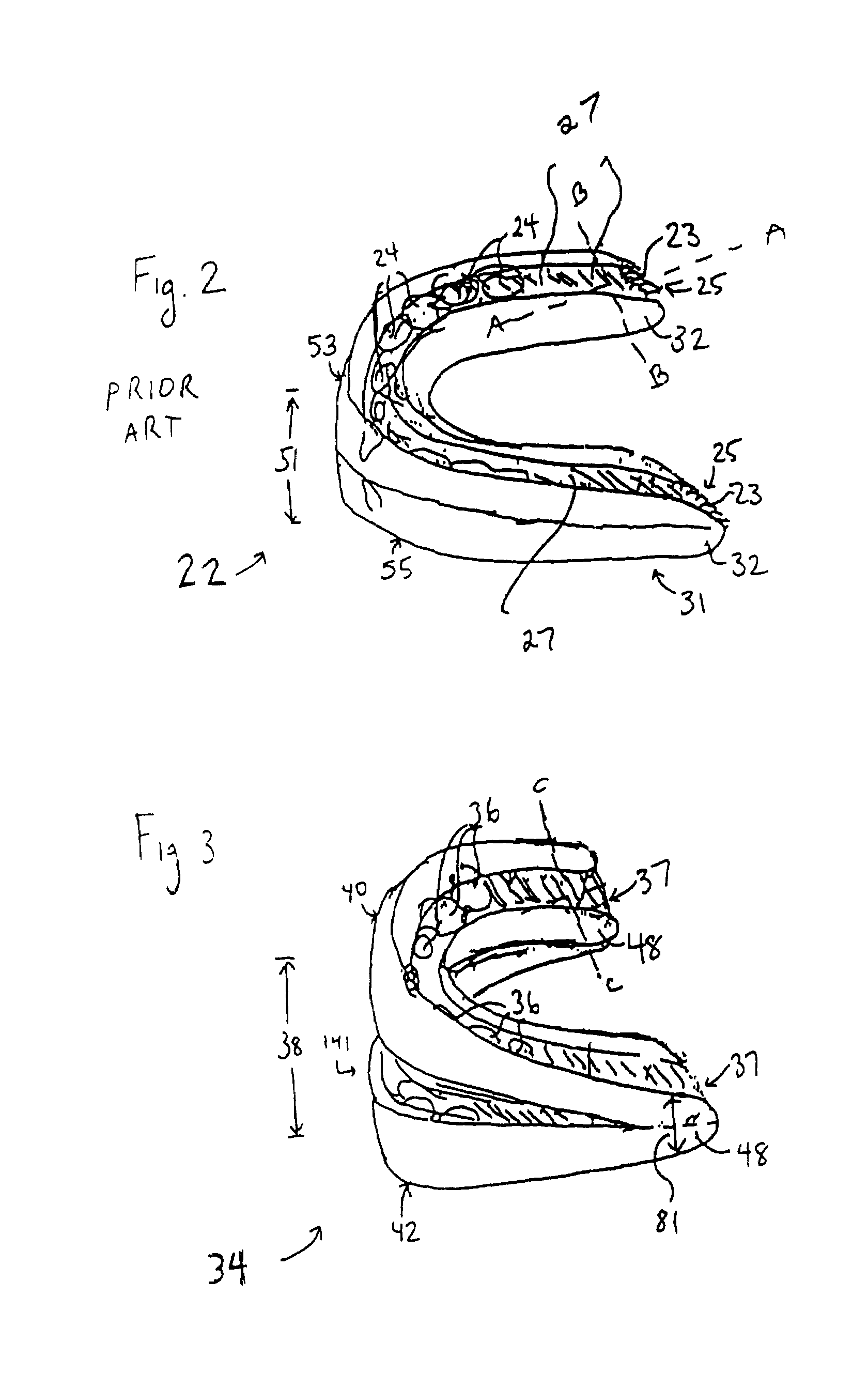 Dental appliance having an altered vertical thickness between an upper shell and a lower shell with an integrated hinging mechanism to attach an upper shell and a lower shell and a system and a method for treating malocclusions