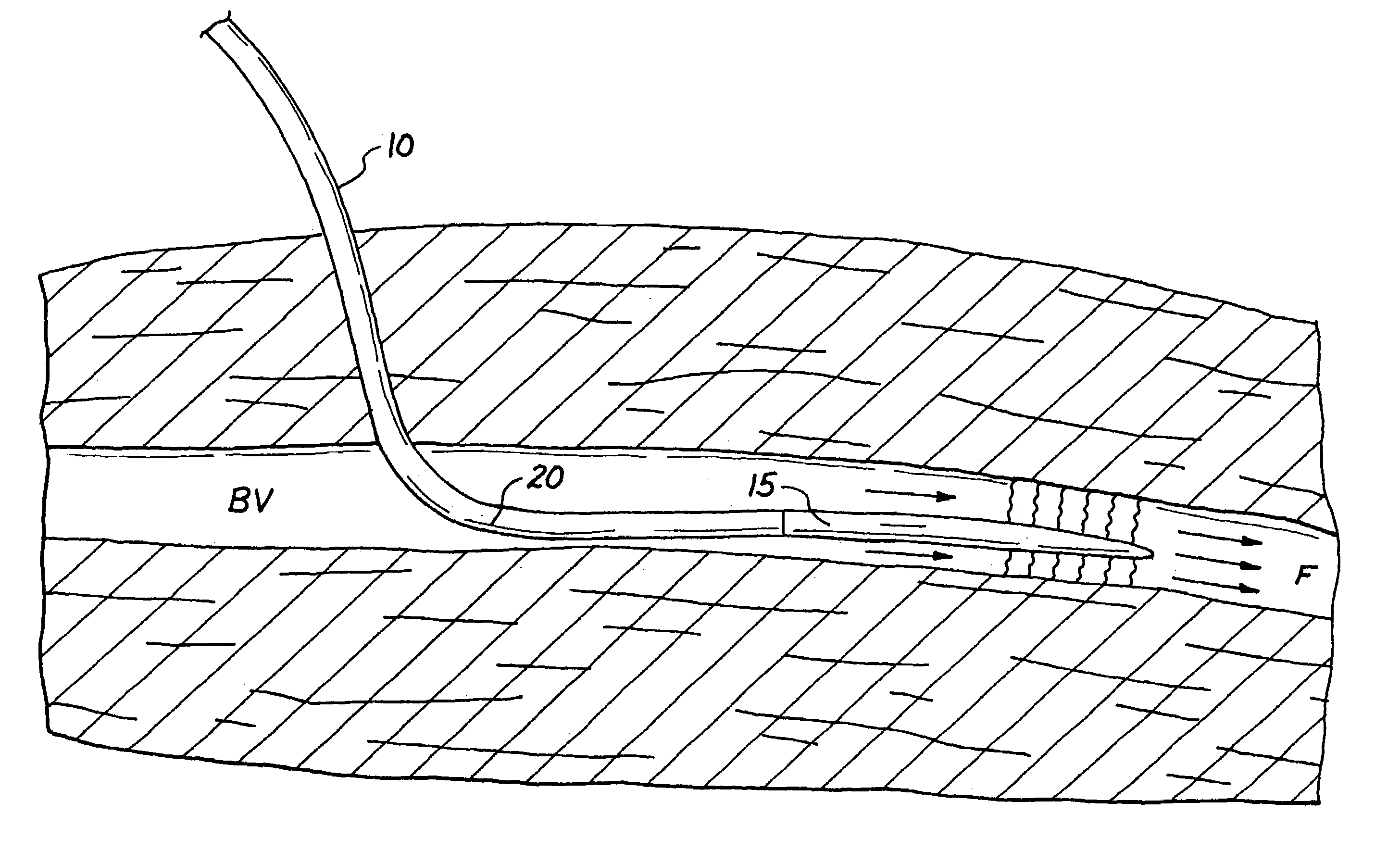 Methods and apparatus for regional and whole body temperature modification