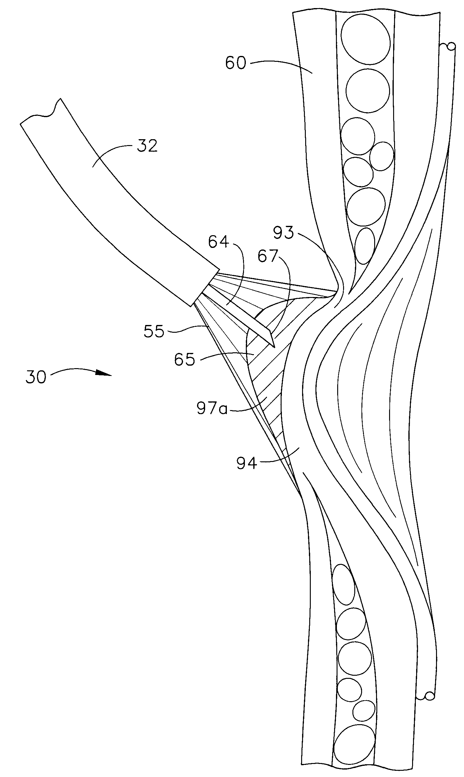 Use of an Adhesive to Treat Intraluminal Bleeding