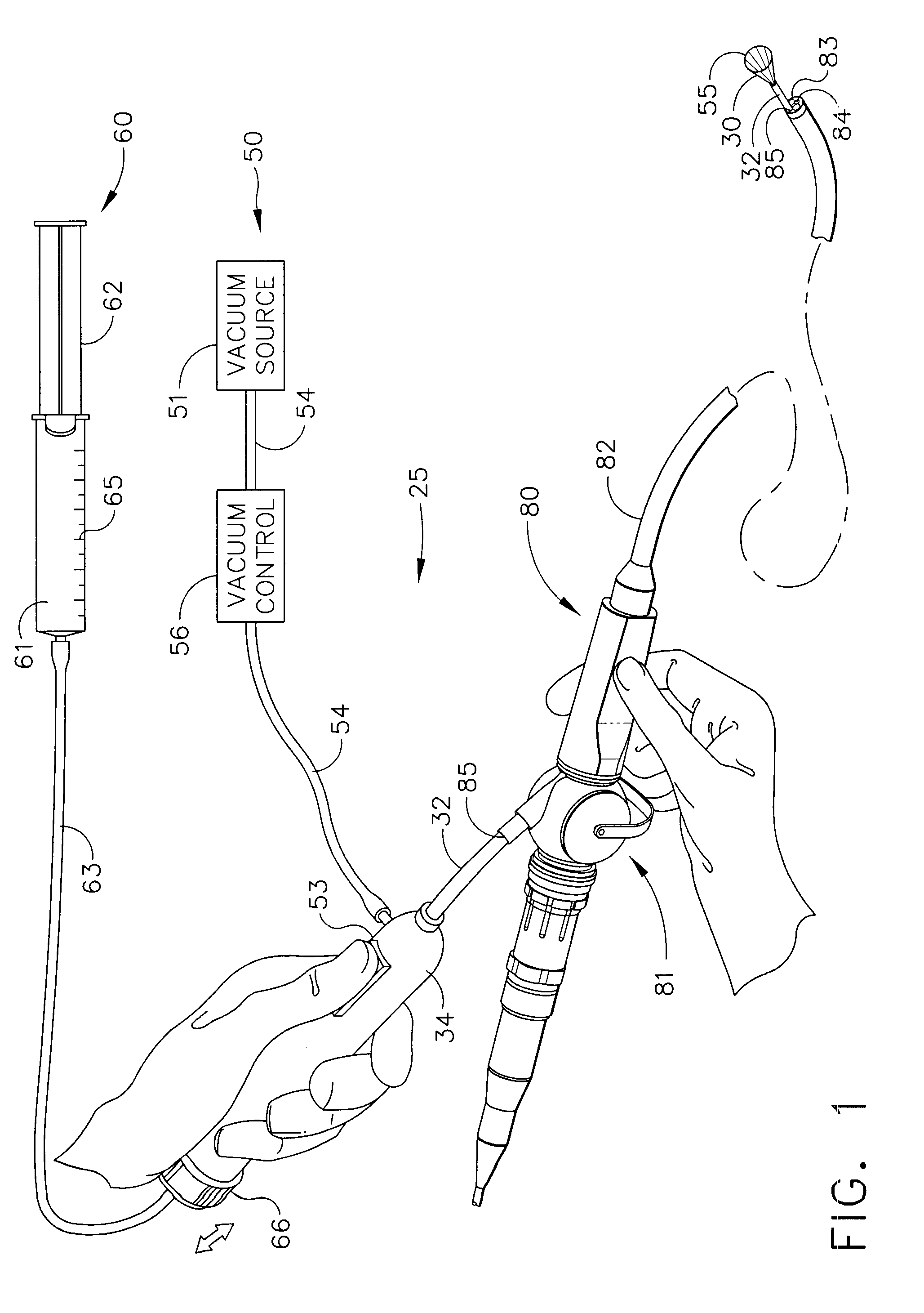 Use of an Adhesive to Treat Intraluminal Bleeding