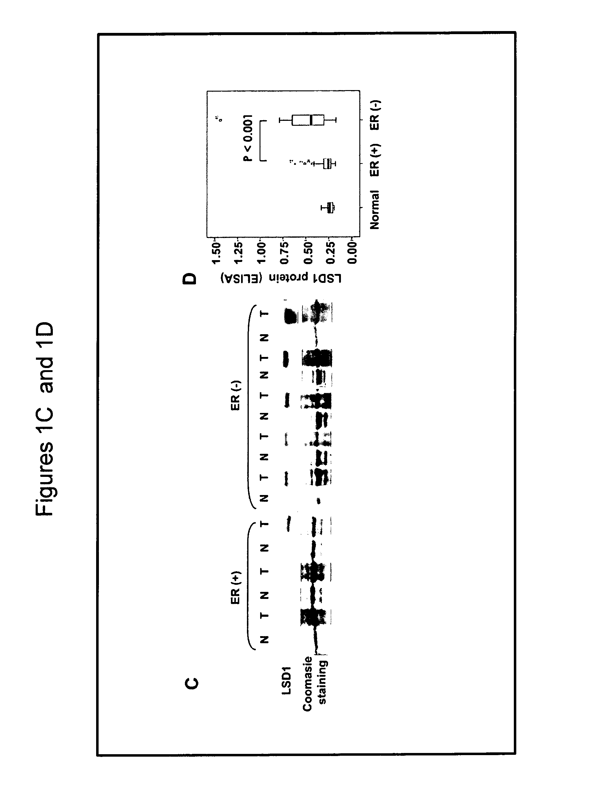 Lysine-specific demethylase 1(LSD1) is a biomarker for breast cancer