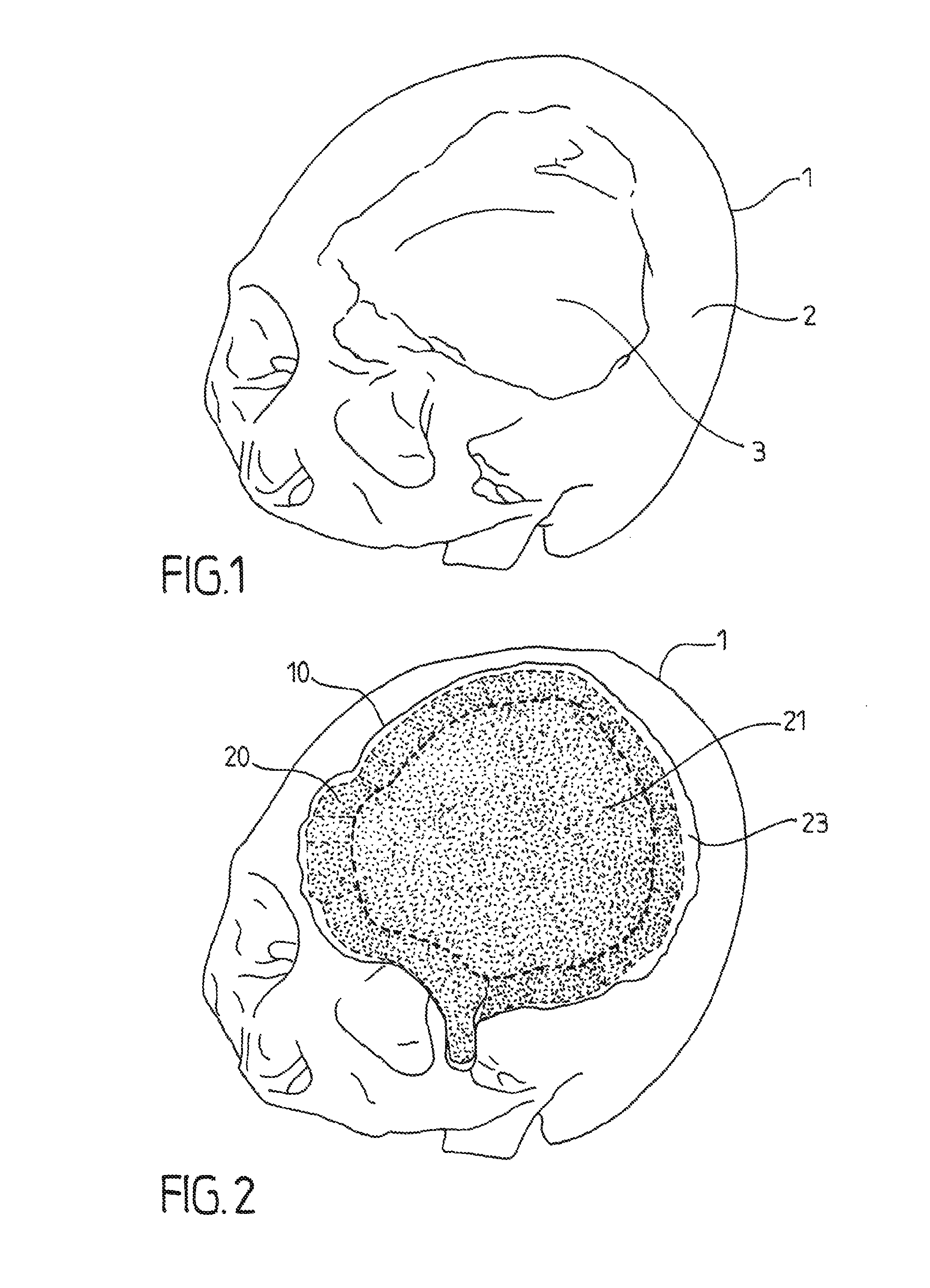 Reinforced biocompatible ceramic implant and manufacturing method thereof