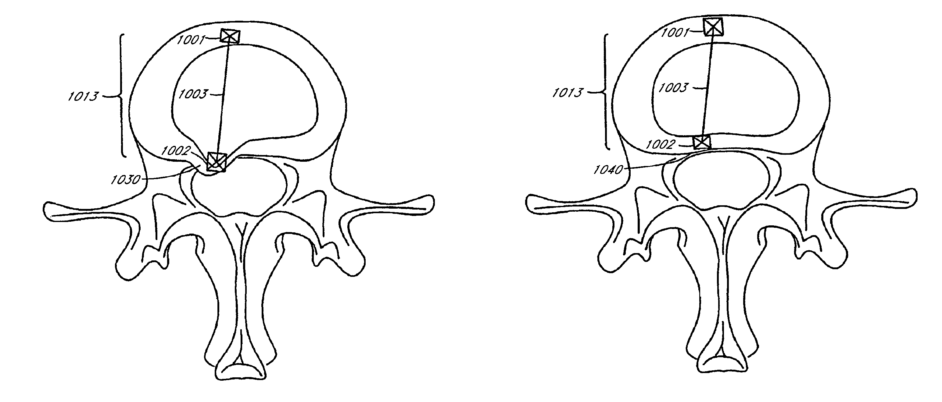 Method of treating a herniated disc