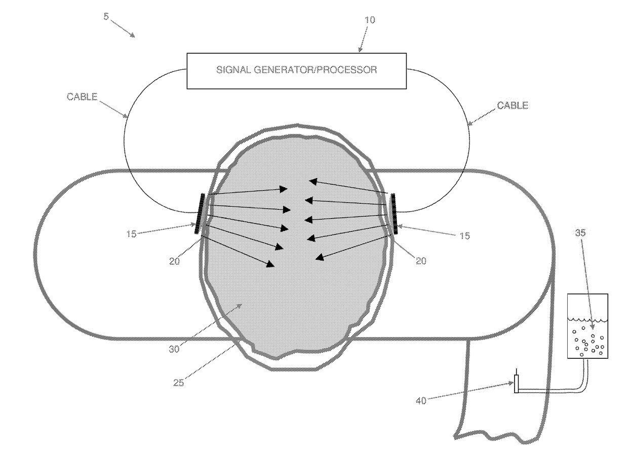 Automated ultrasound apparatus and method for noninvasive vessel recanalization treatment and monitoring