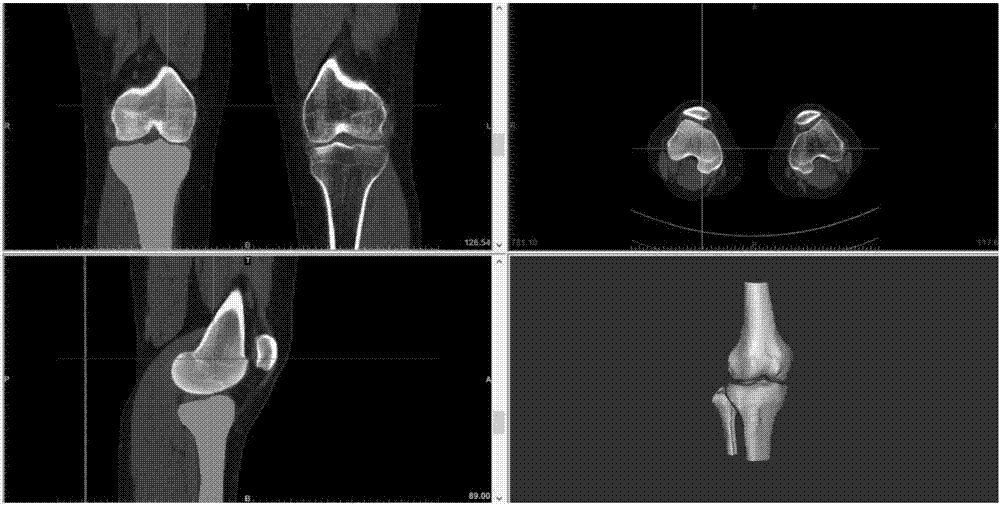 Knee-joint discoid meniscus surgery simulation method