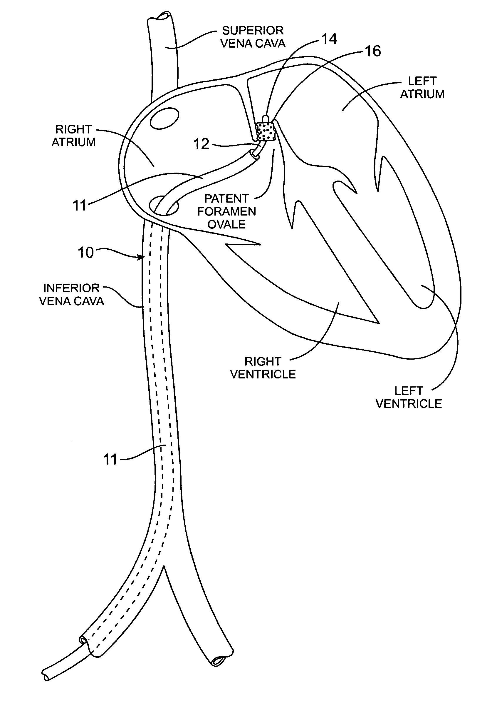 Methods and apparatus for treatment of patent foramen ovale