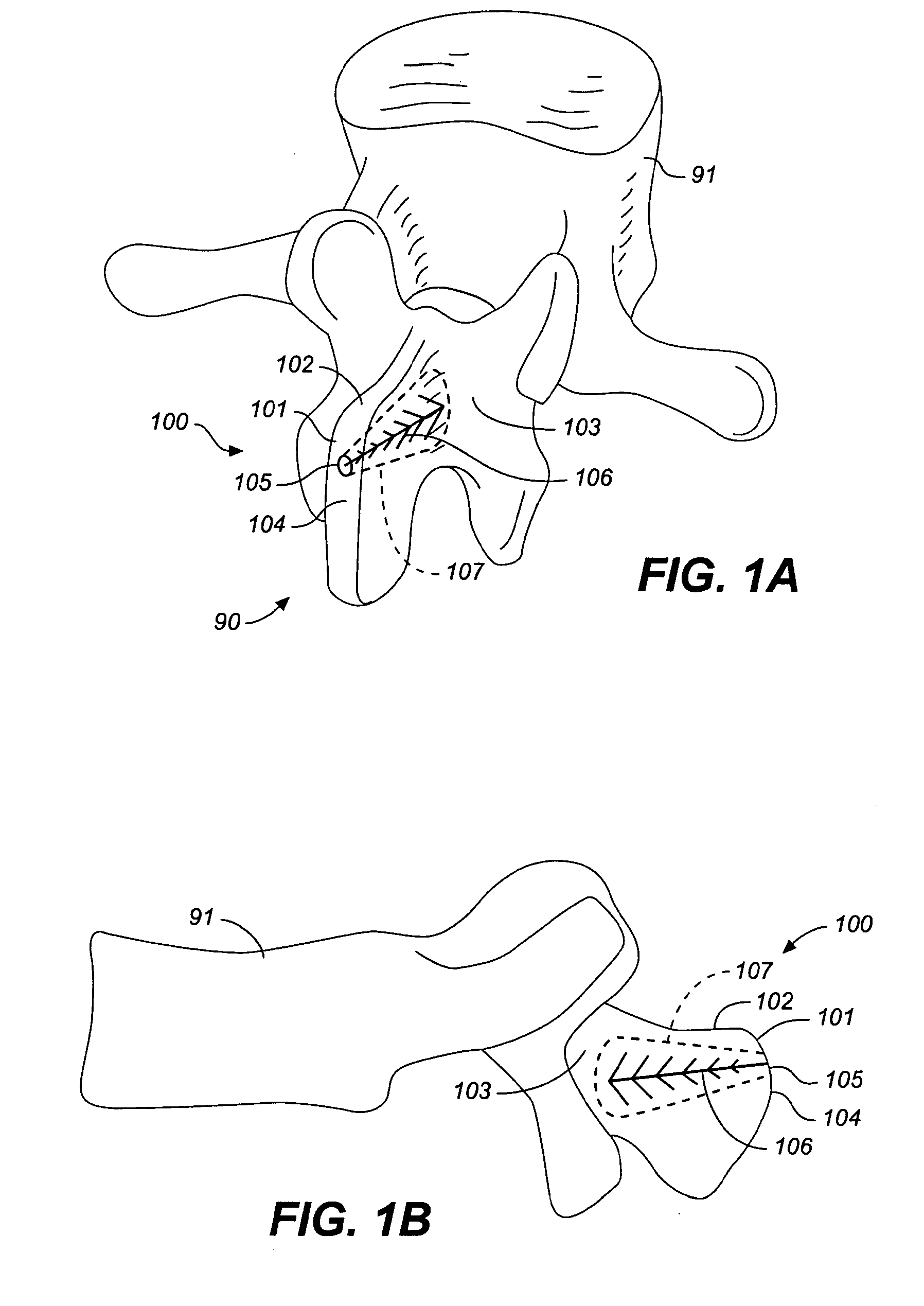 Device and method for correcting a spinal deformity