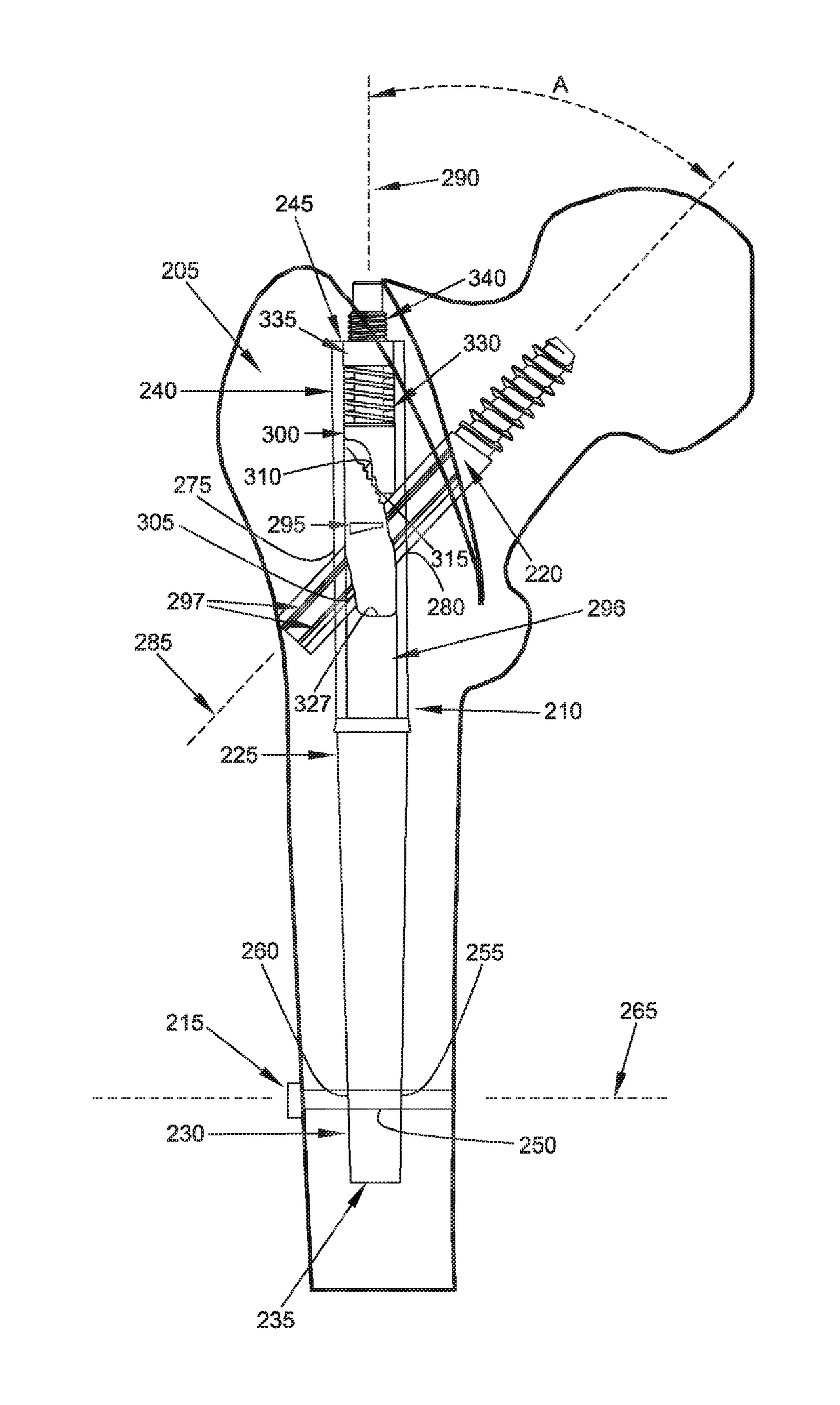 Interlocking intramedullary rod assembly for proximal femoral fractures, including unstable hip fractures