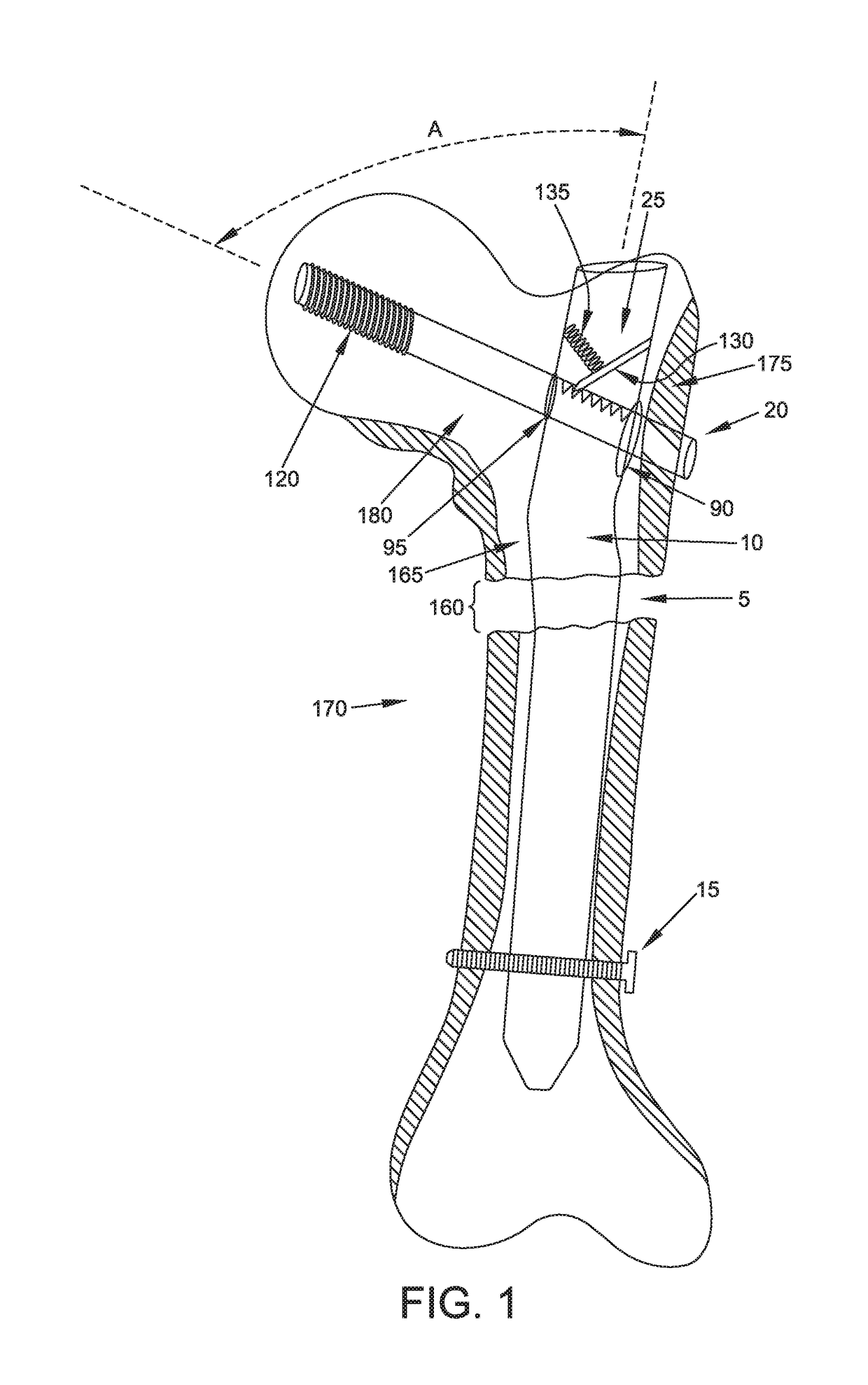 Interlocking intramedullary rod assembly for proximal femoral fractures, including unstable hip fractures