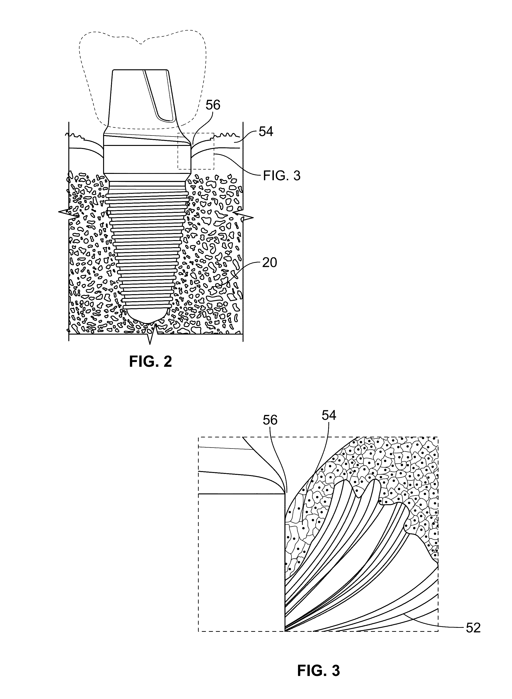 Modification of root form dental implants for accelerated tissue regeneration