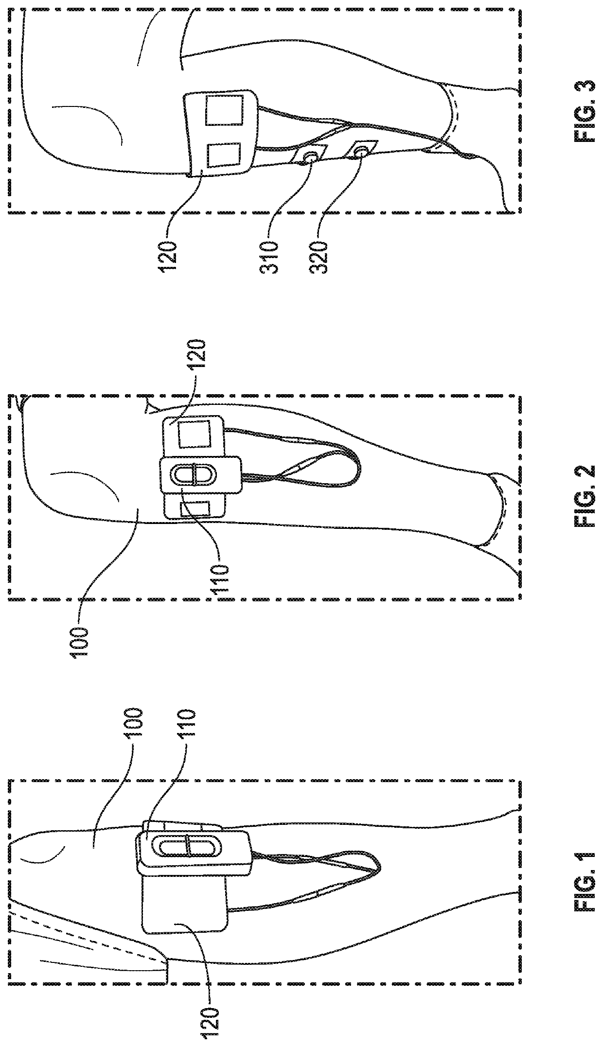 Peripheral nerve stimulation for restless legs syndrome