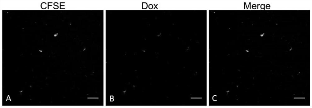 A tumor drug-loaded microparticle preparation and its preparation method