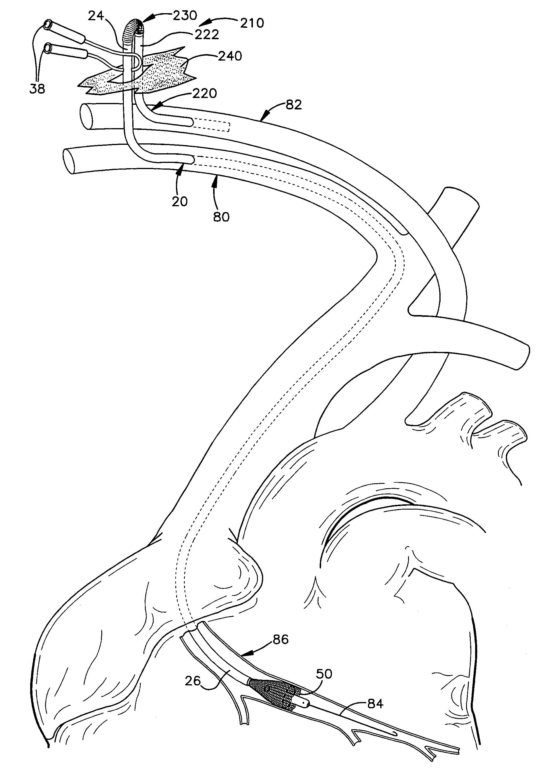 Apparatus and method for auto-retroperfusion of a coronary vein