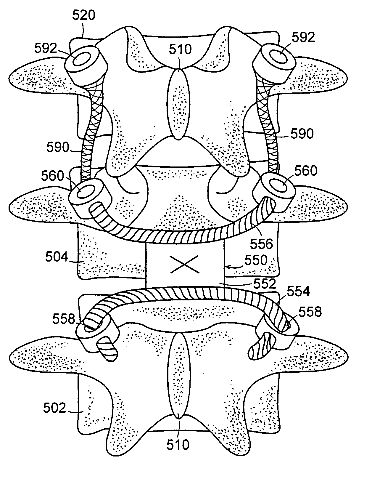 Facet joint and spinal ligament replacement