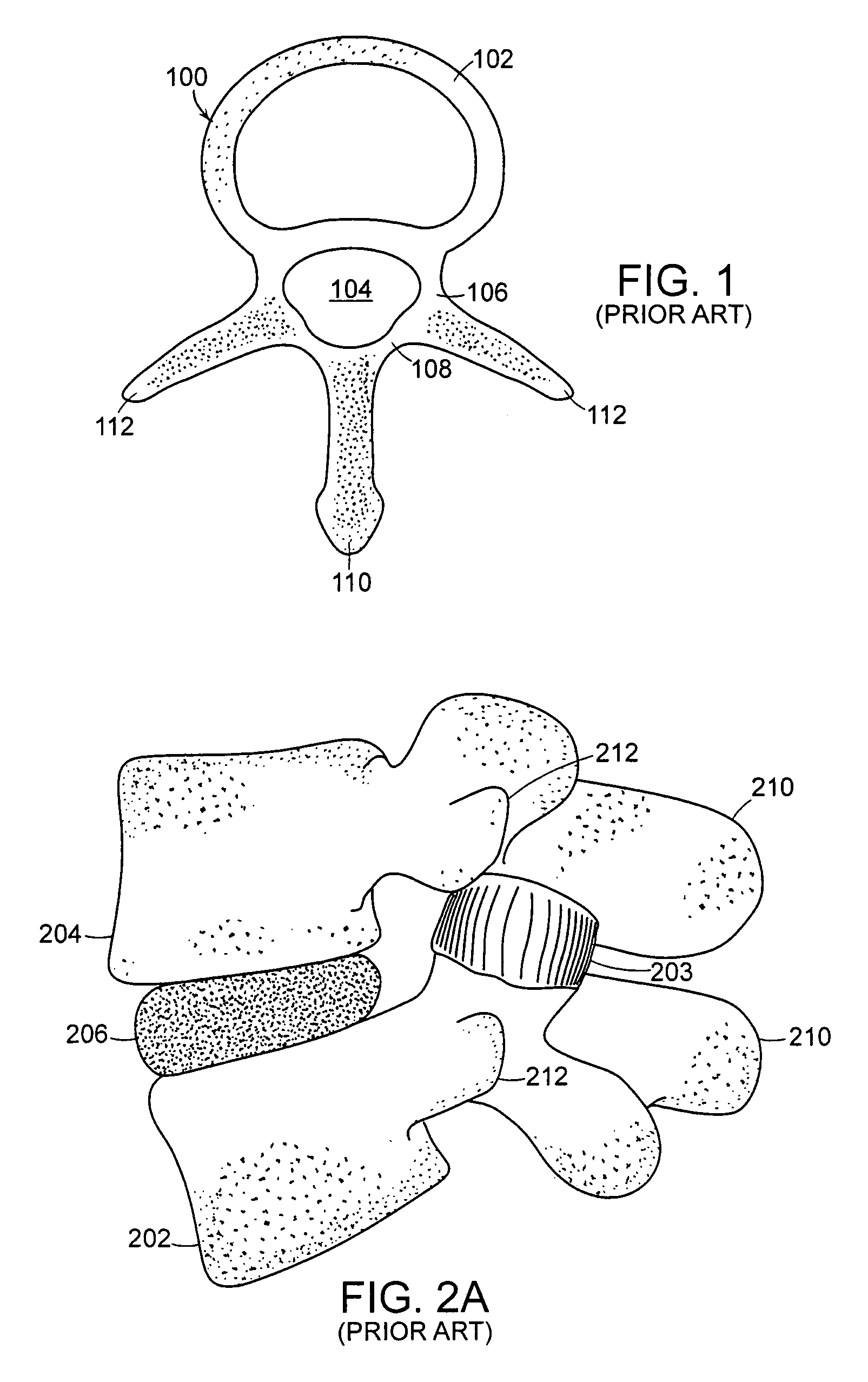 Facet joint and spinal ligament replacement