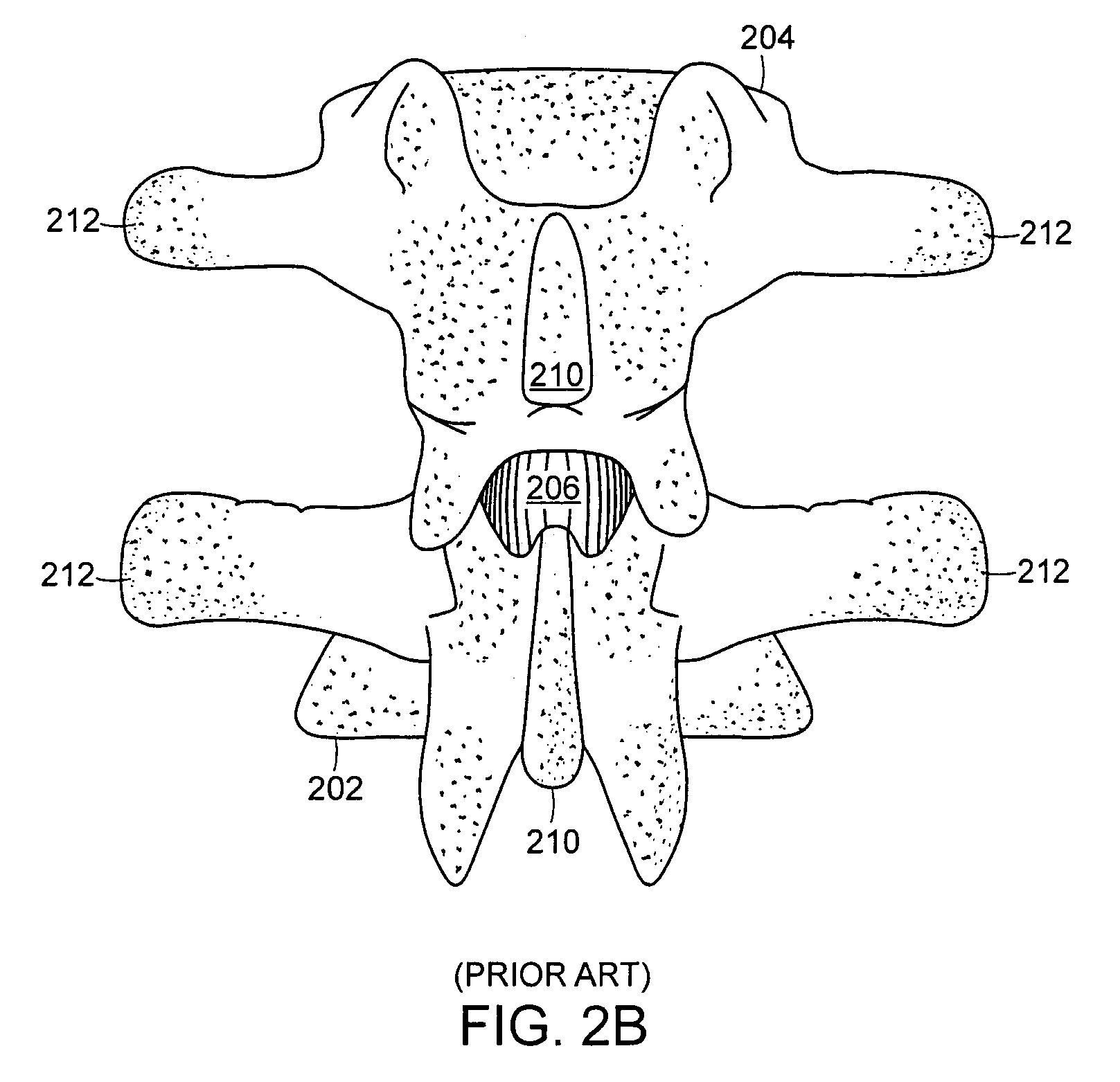 Facet joint and spinal ligament replacement