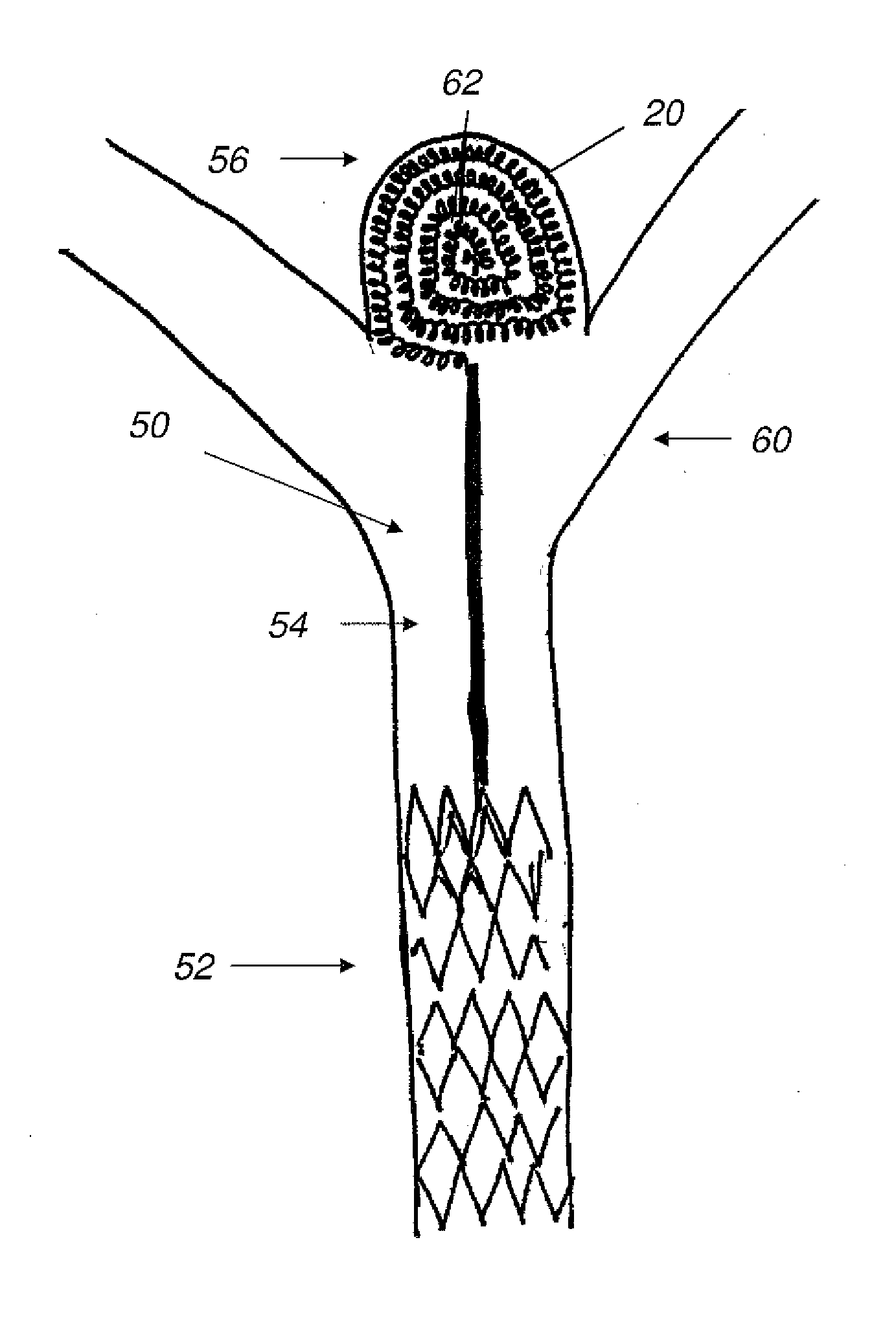 Vascular remodeling device