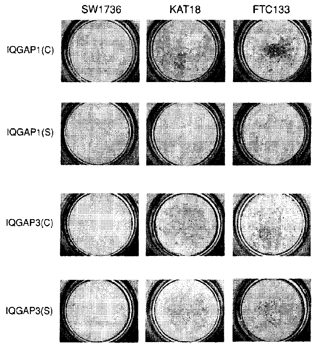 Genetic amplification of iqgap1 in cancer