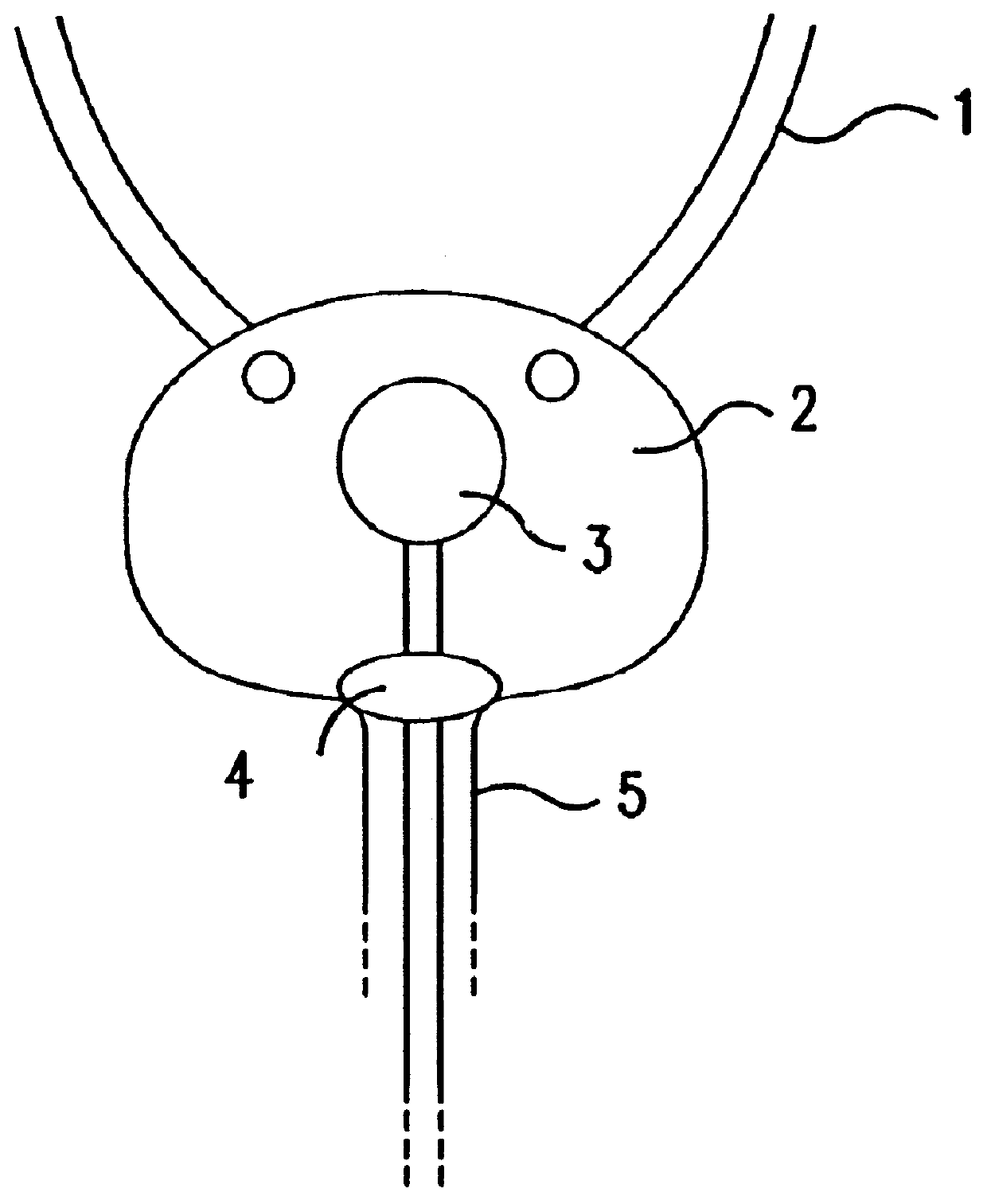 Method and device for use in the diagnosis of inflammatory states in the urogenital tract