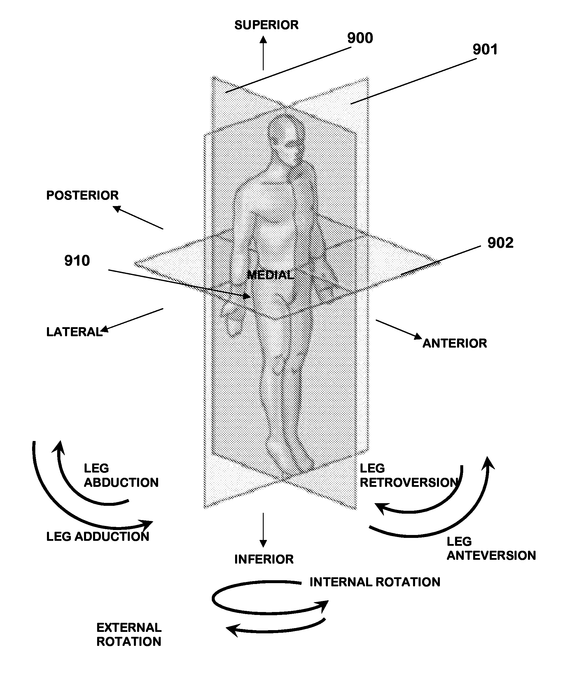 Method and system of mapping femoral head for acetabular prosthesis alignment