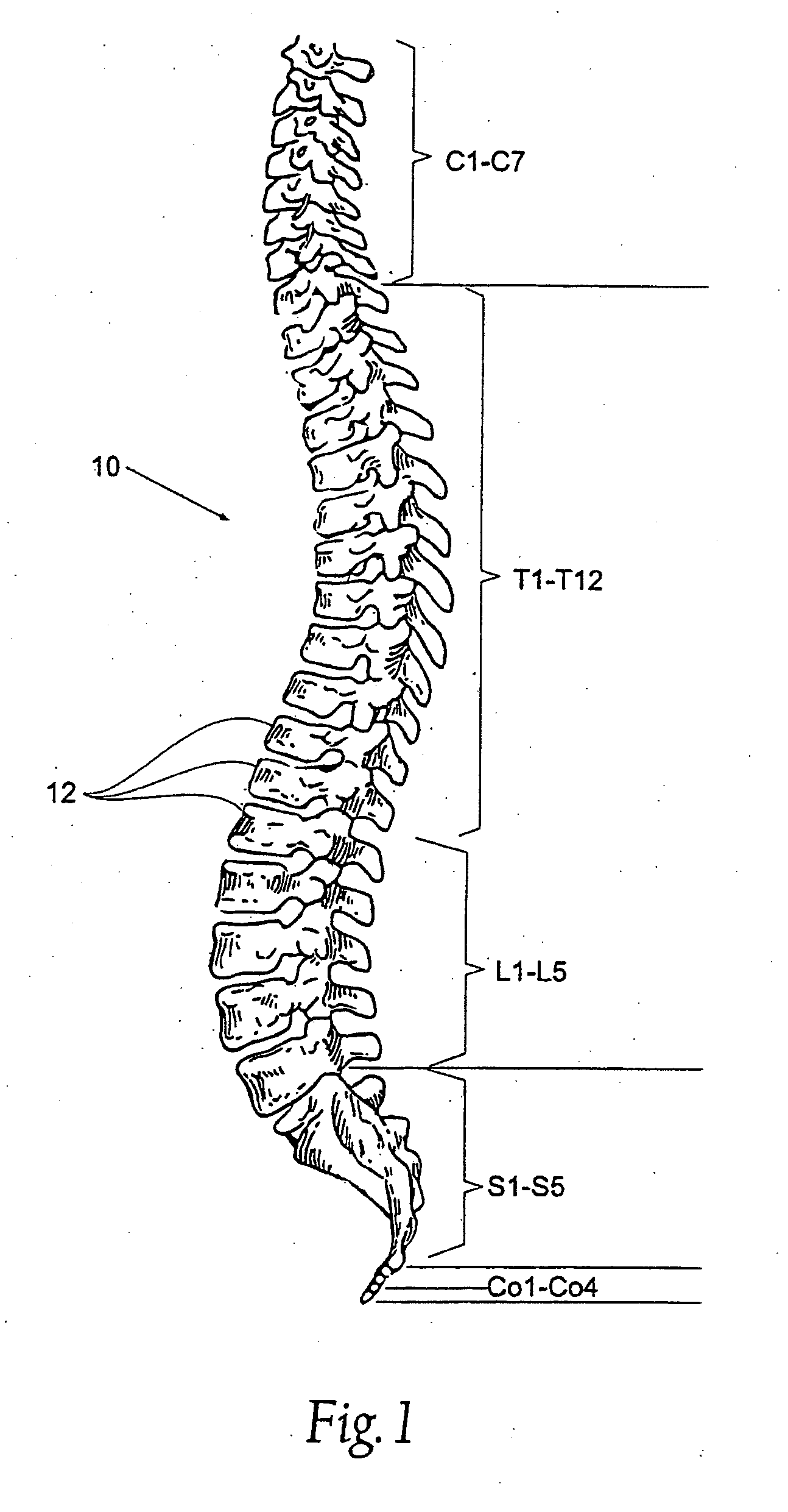 Prostheses, Systems and Methods for Replacement of Natural Facet Joints With Artificial Facet Joint Surfaces