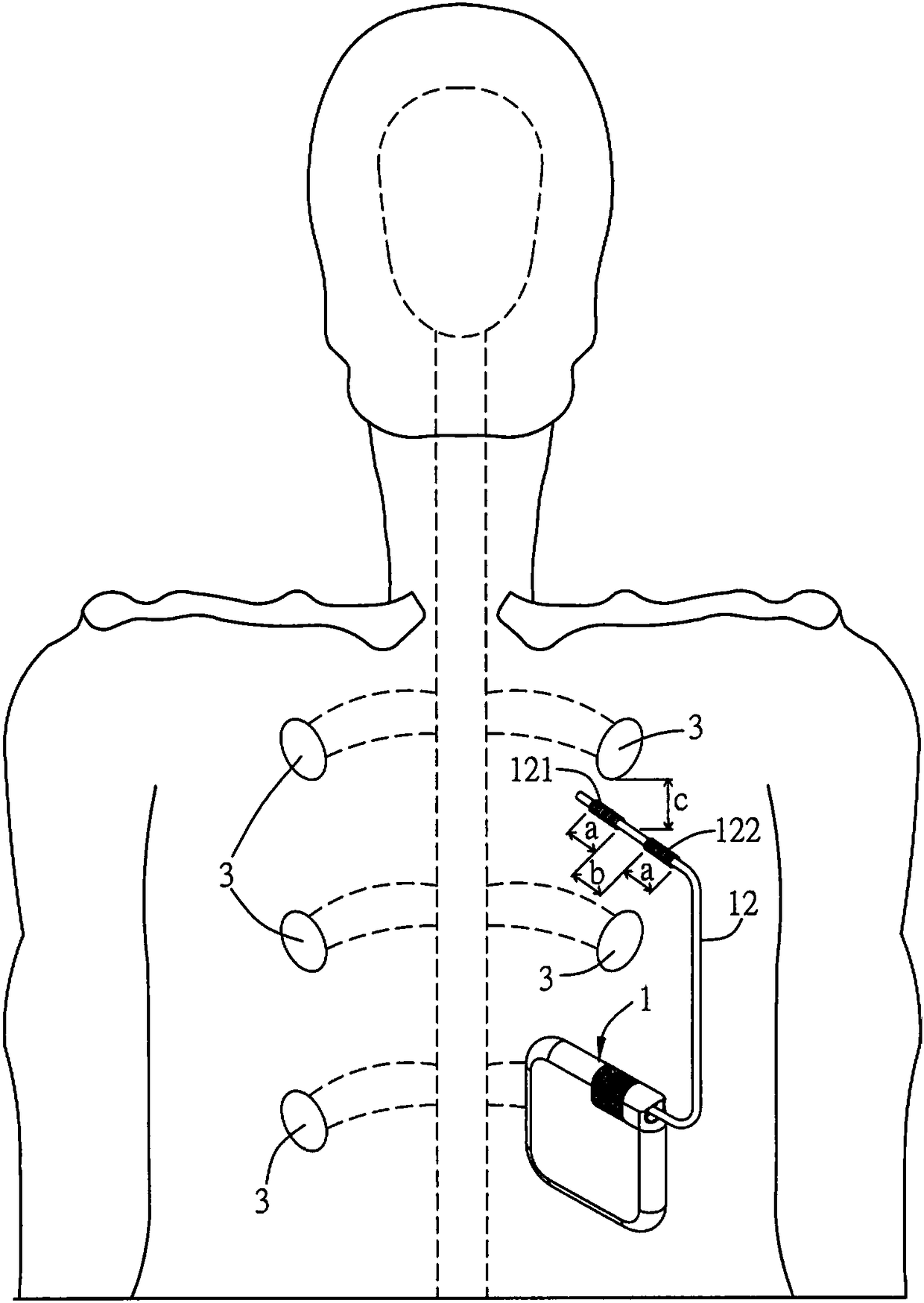 Electronic stimulation device, method of treatment and electronic stimulation system