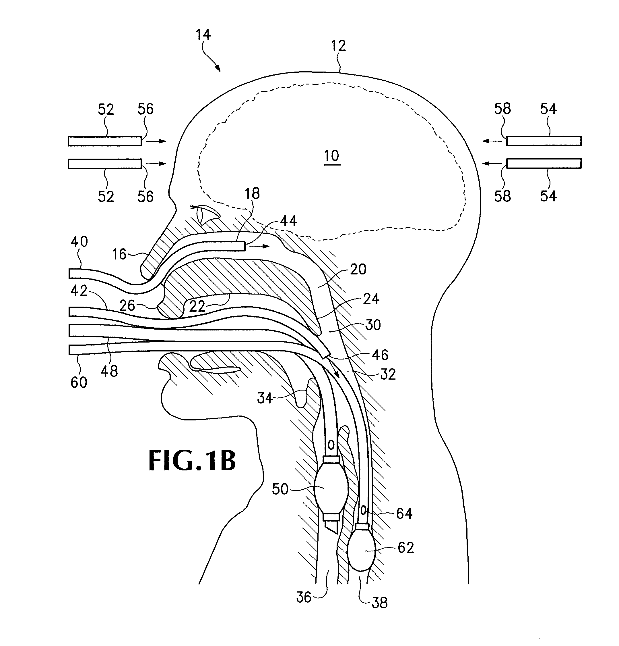 Rapid Cooling of Body and/or Brain by Irrigating with a Cooling Liquid