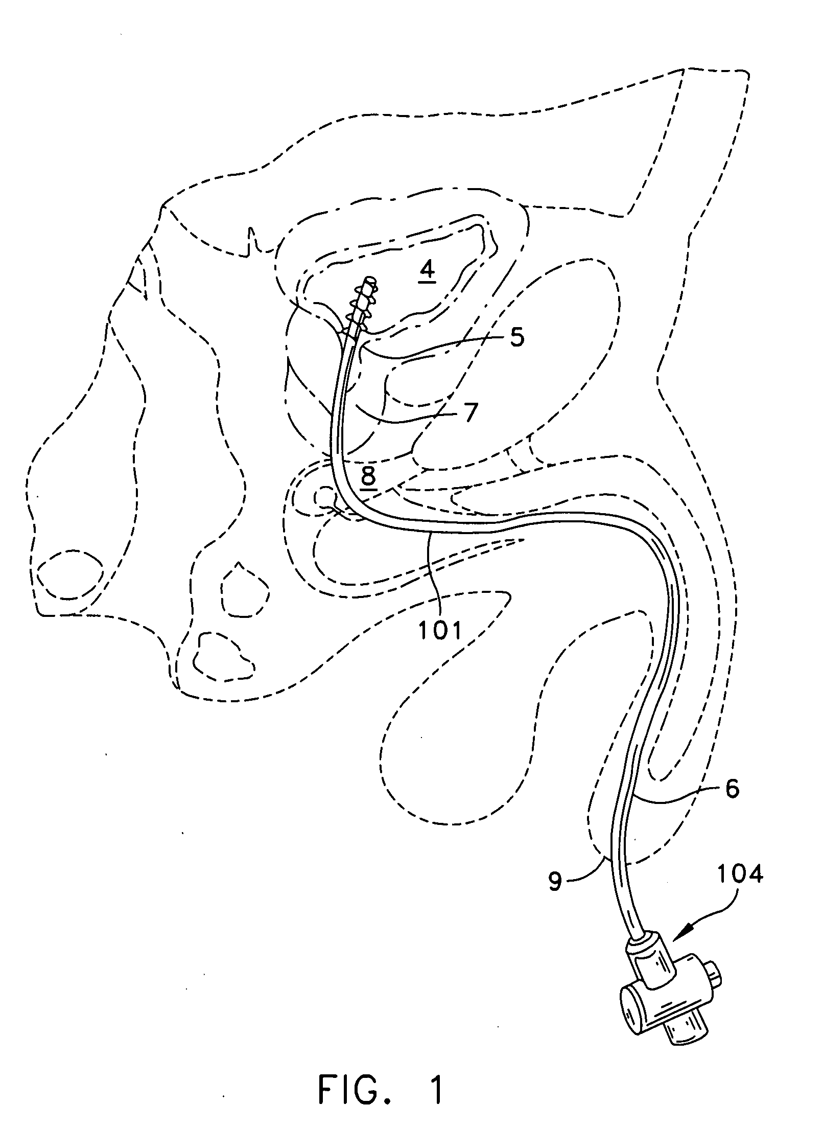 Rotate-to-advance catheterization system