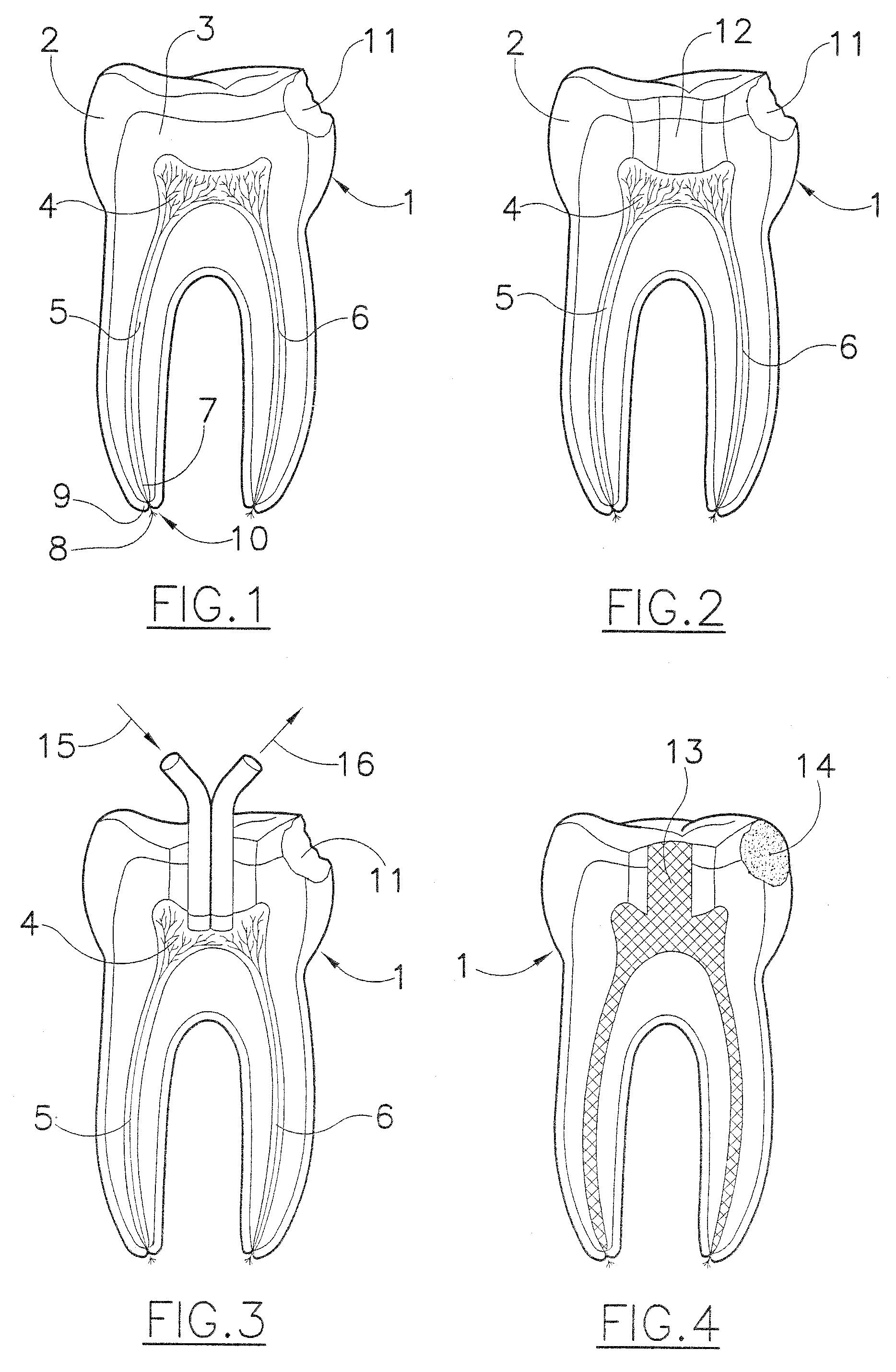 Apparatus for endodontic treatment by circulation of enzymatic solutions in the pulp cavity and in the root canals