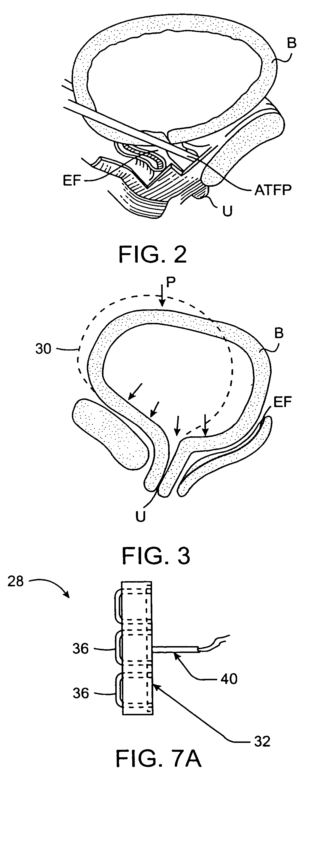 Energy induced bulking and buttressing of tissues for incontinence