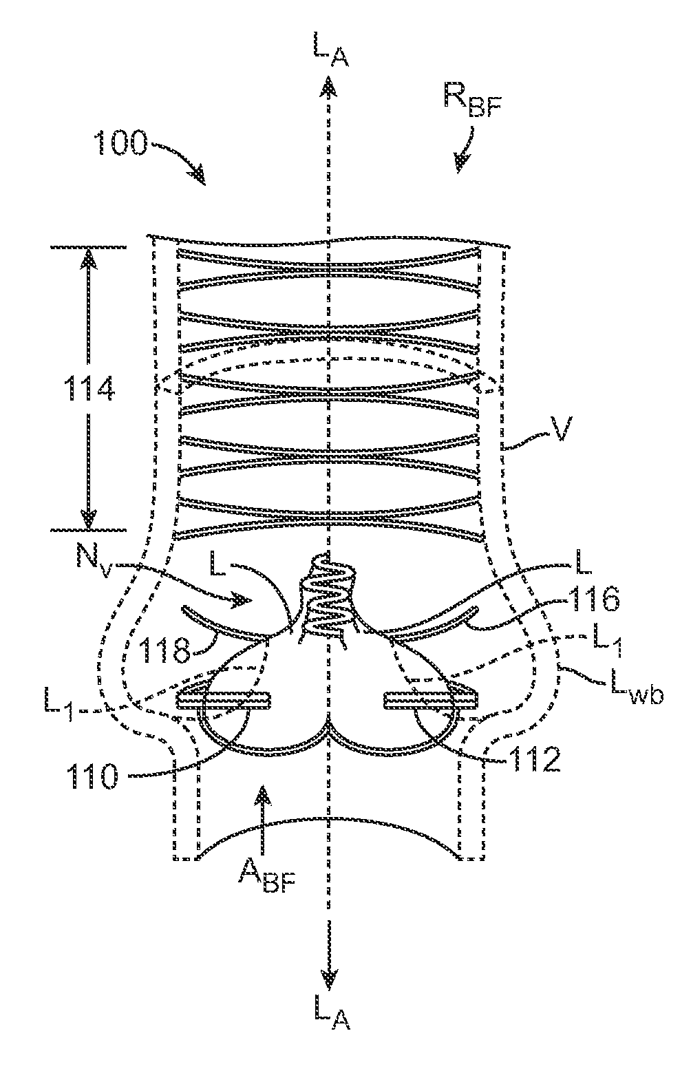 Venous valve repair prosthesis for treatment of chronic venous insufficiency