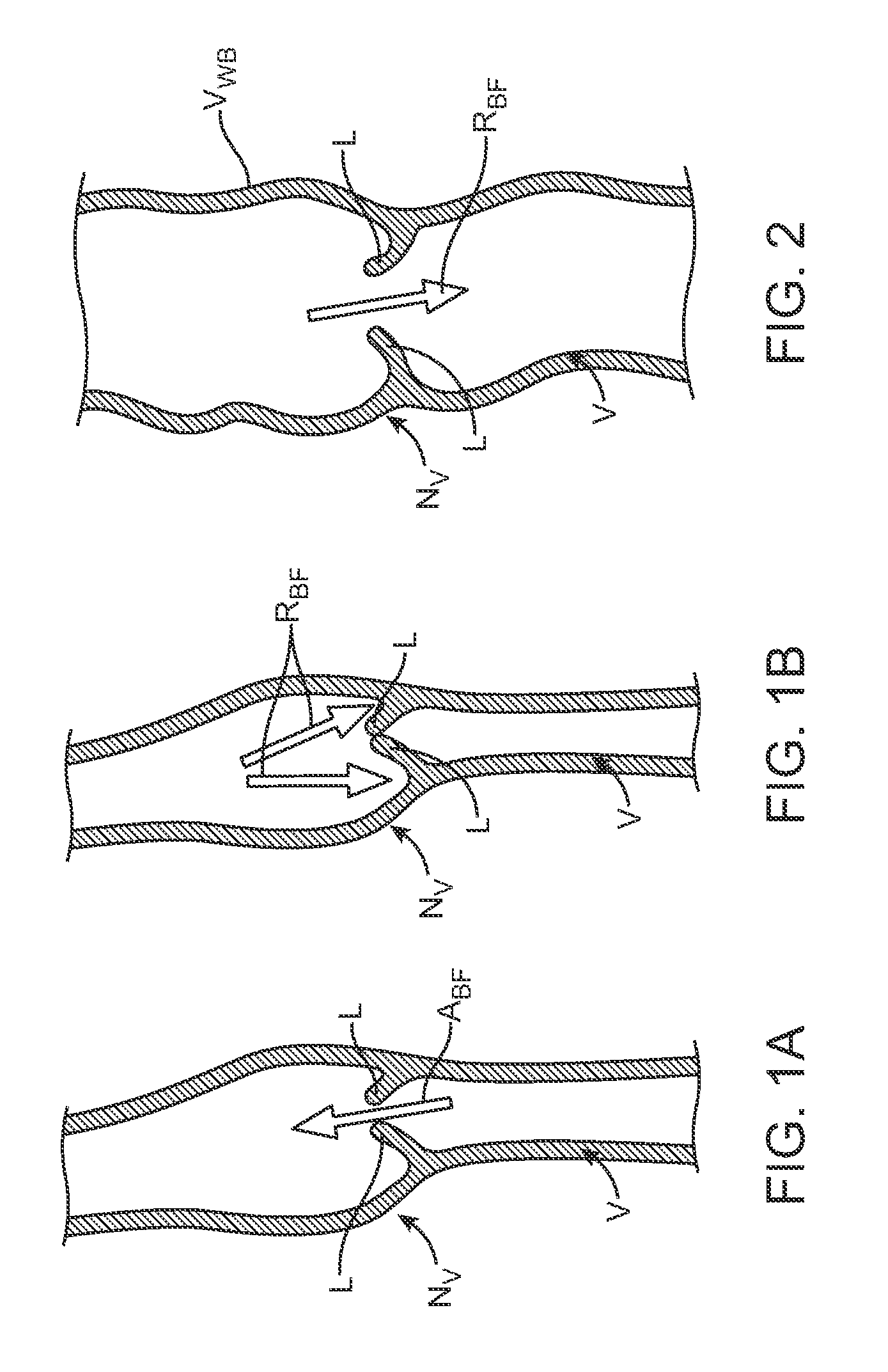 Venous valve repair prosthesis for treatment of chronic venous insufficiency