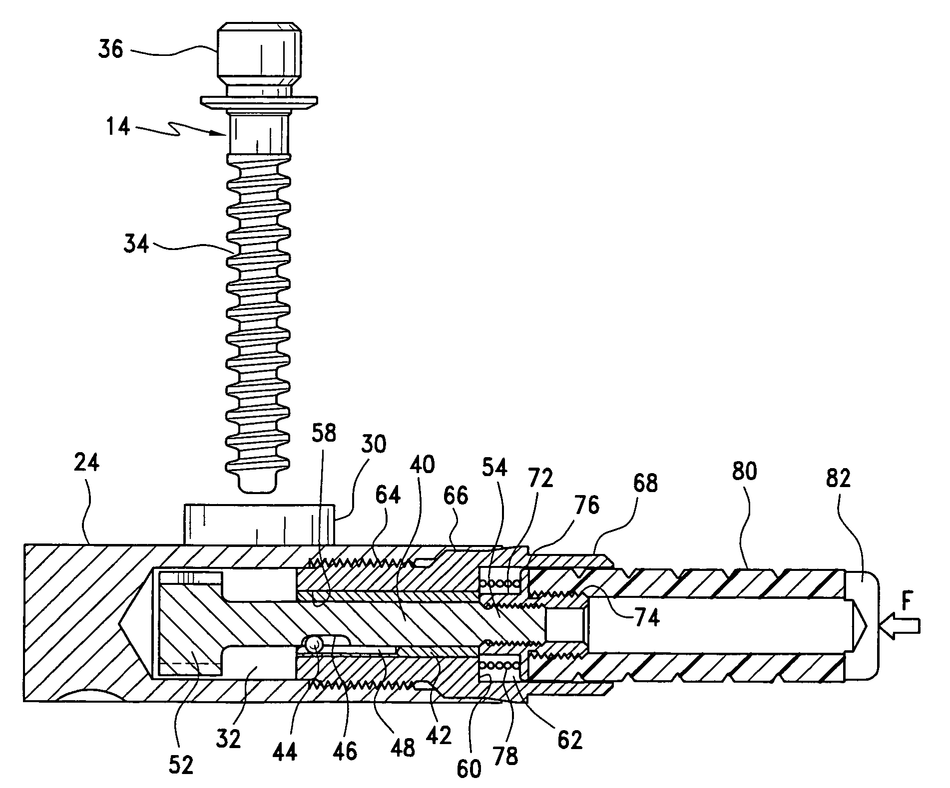 Prosthesis locking assembly