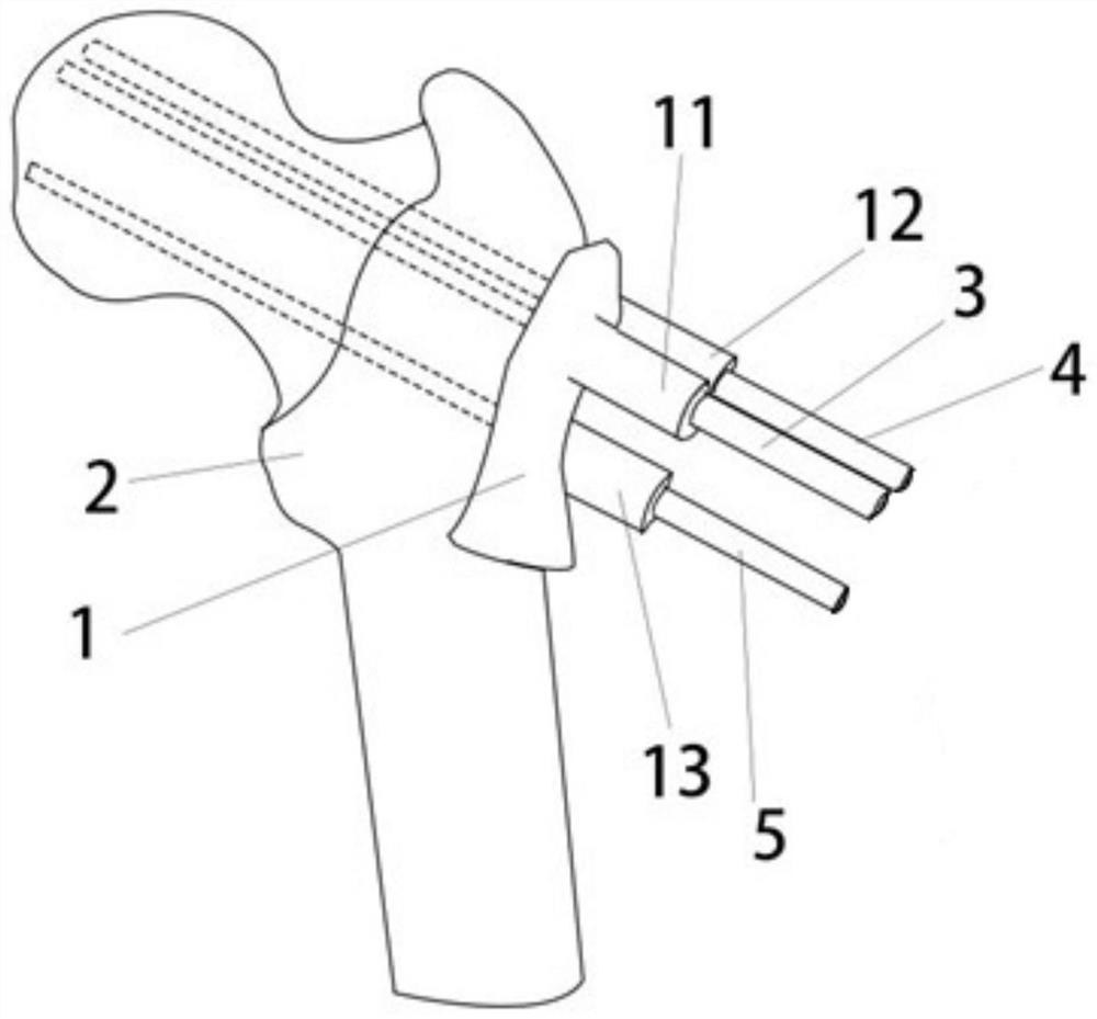 Thighbone screw placement module and manufacturing method thereof