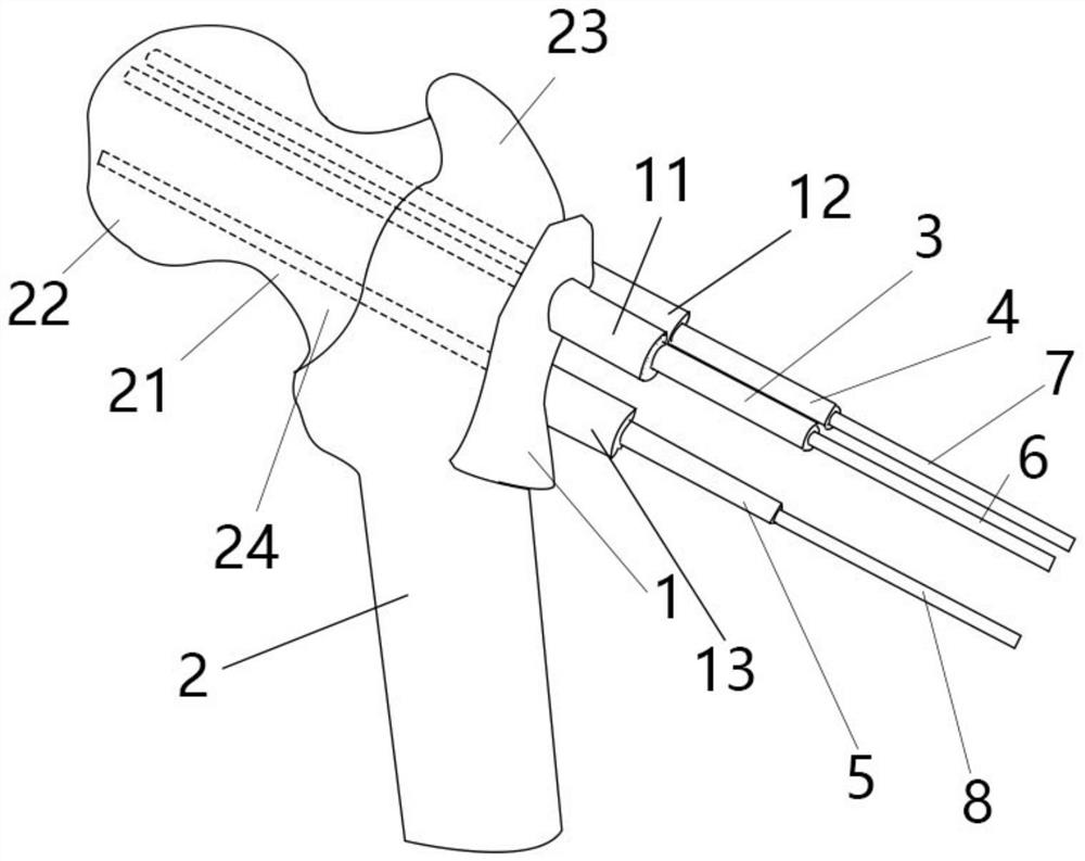 Thighbone screw placement module and manufacturing method thereof