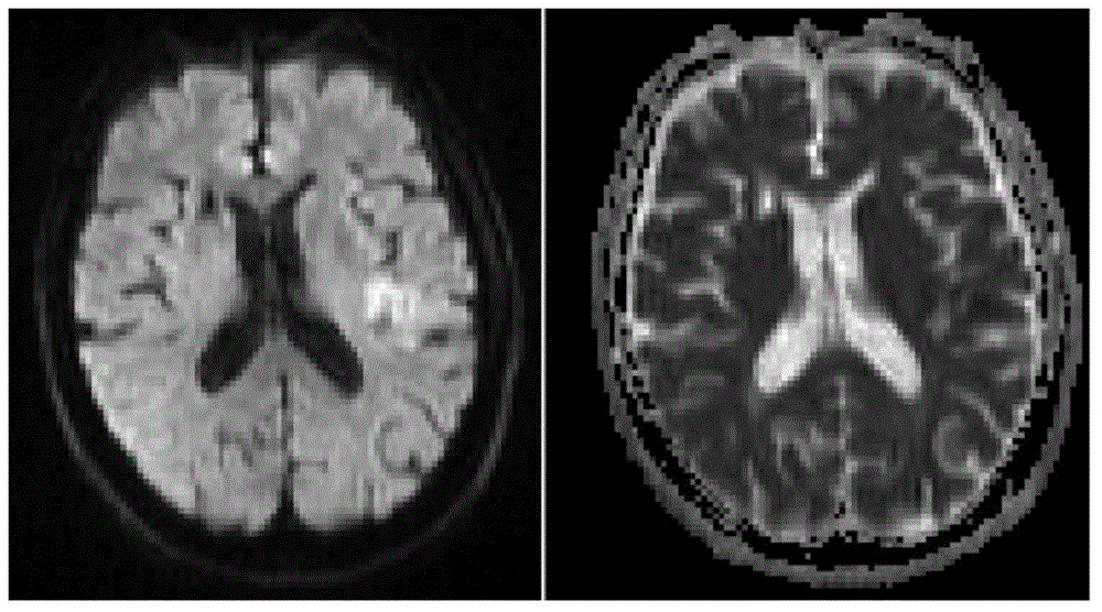 Analyzing and processing method for analyzing and processing magnetic resonance image of acute ischemic stroke