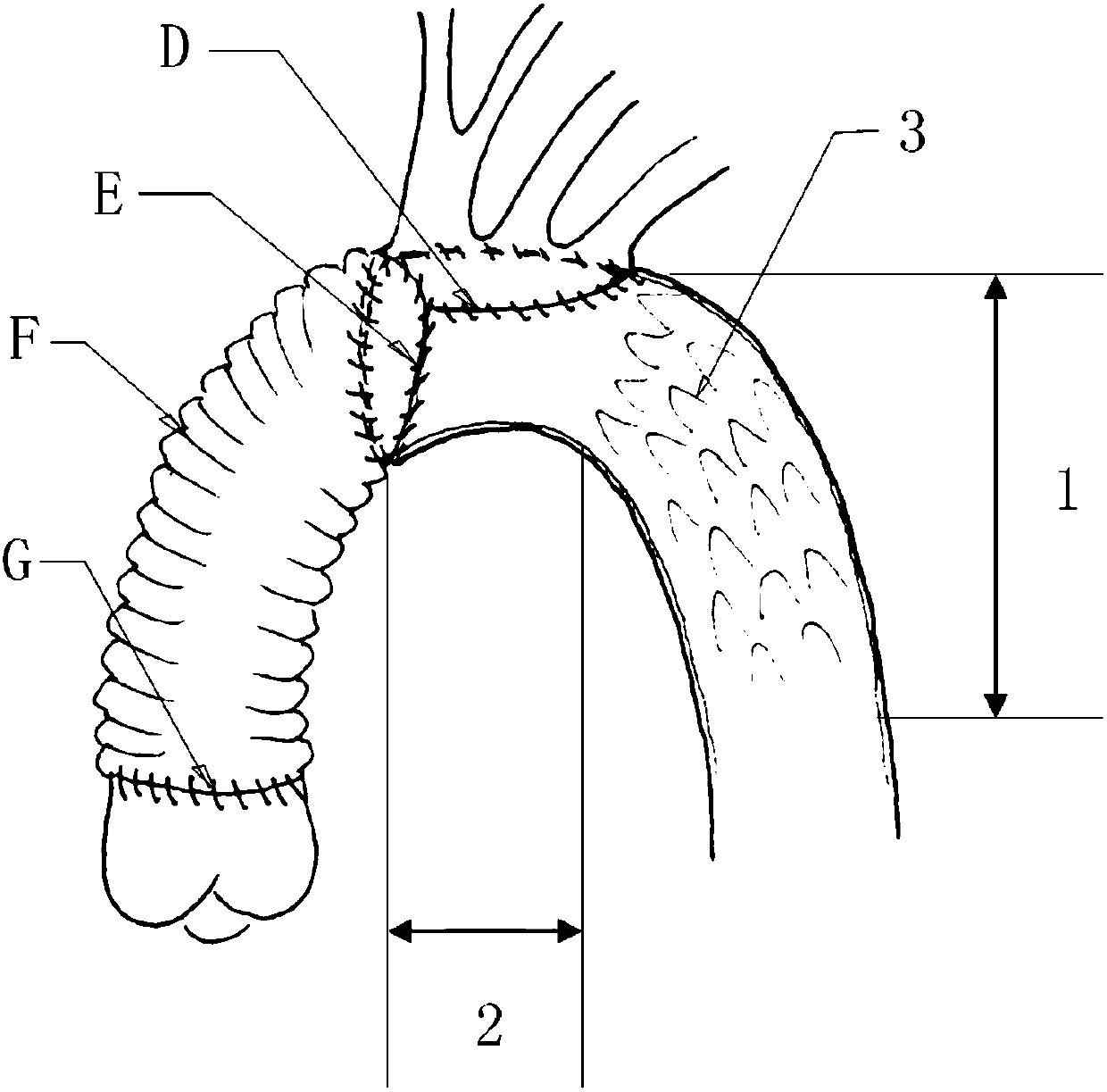 Artificial blood vessel with stent and application of artificial blood vessel in Stanford A type aortic dissection clinical operations