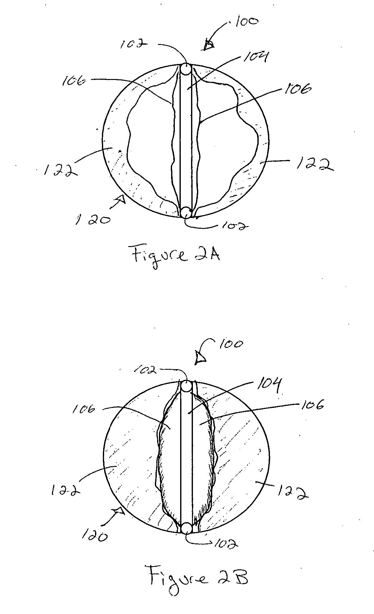 Device and method for treatment of heart valve regurgitation