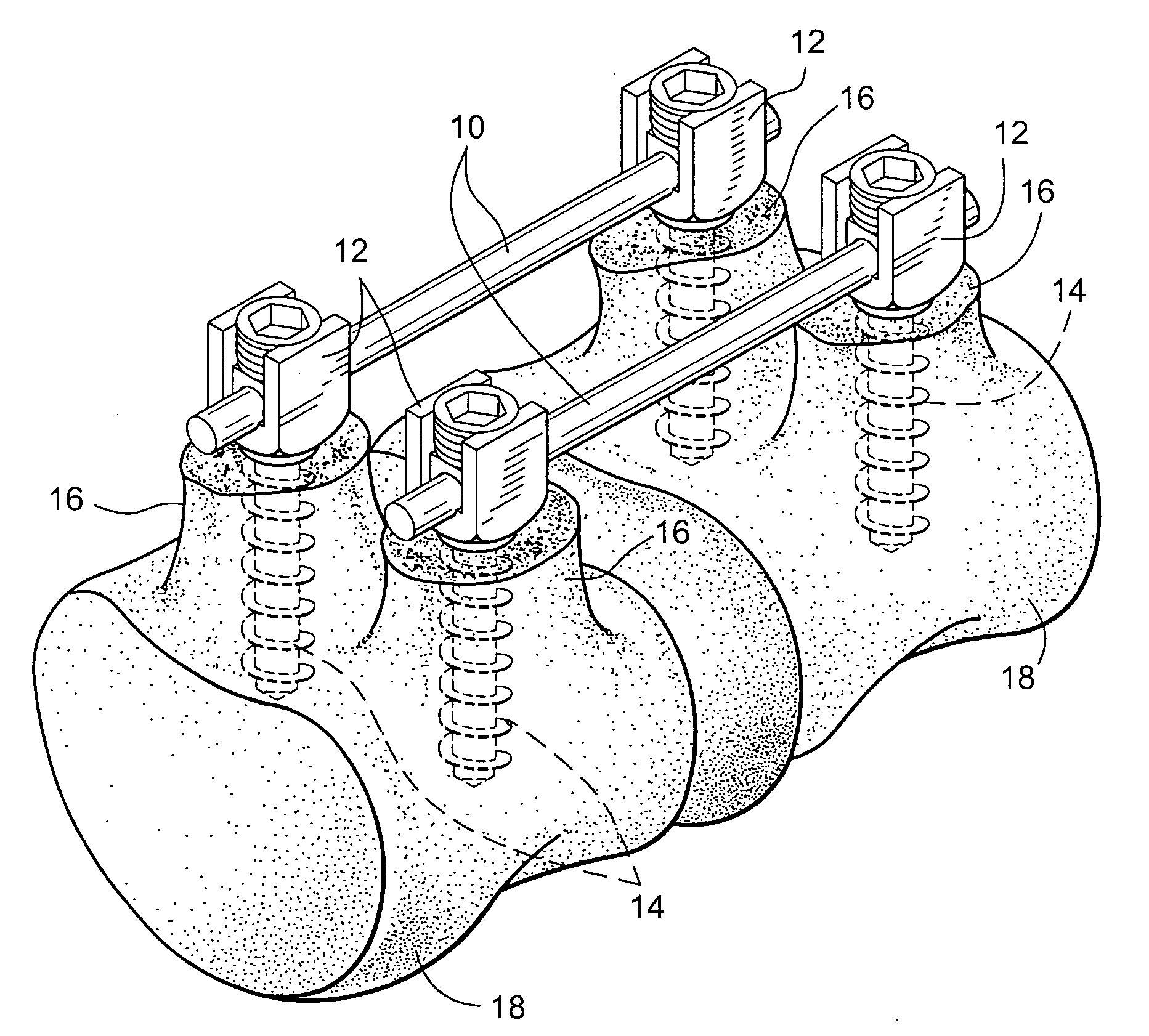 Apparatus and method for flexible spinal fixation